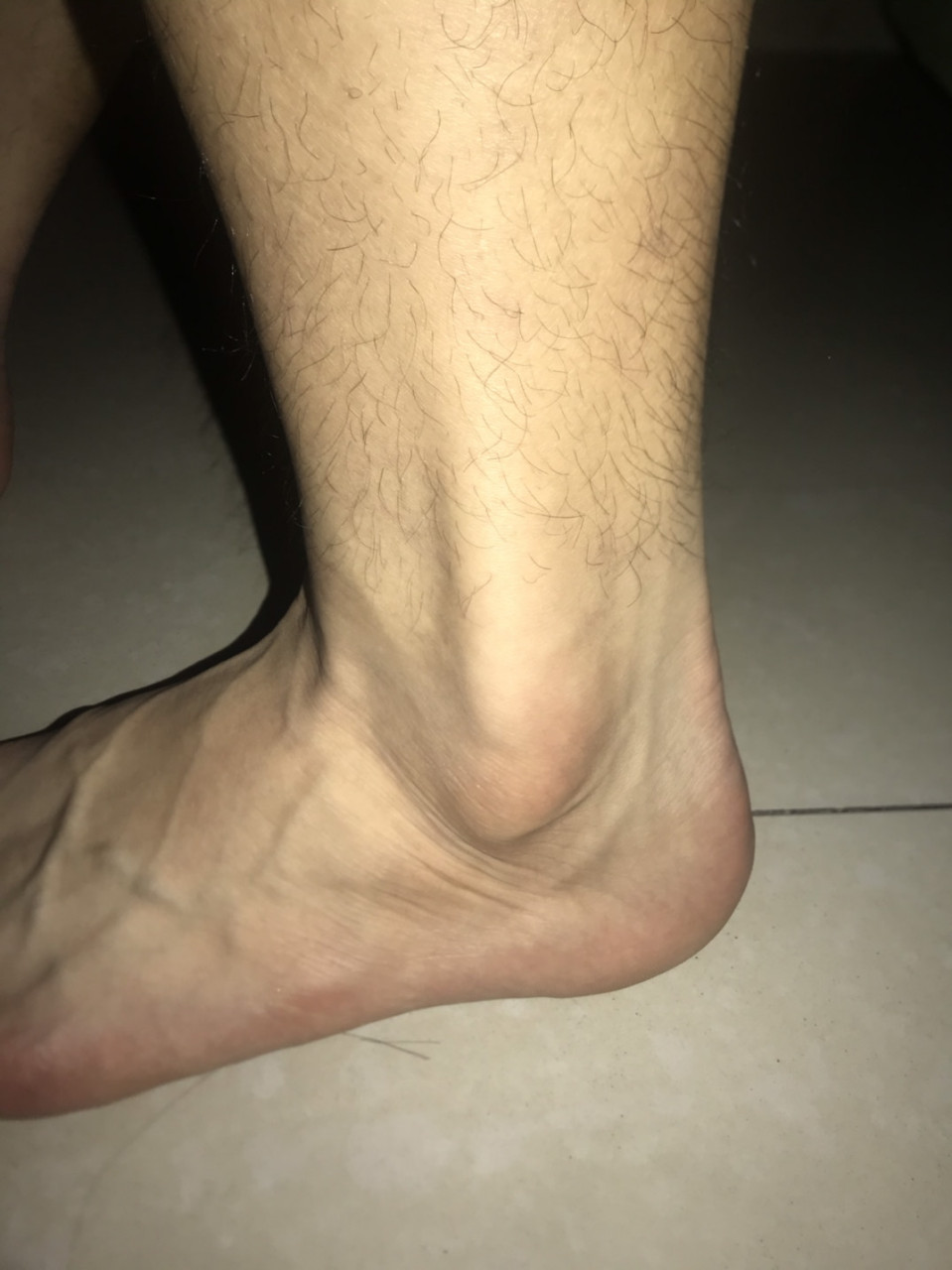 有没有 踝关节肌腱滑脱的兄弟啊 你们都是咋治疗的啊