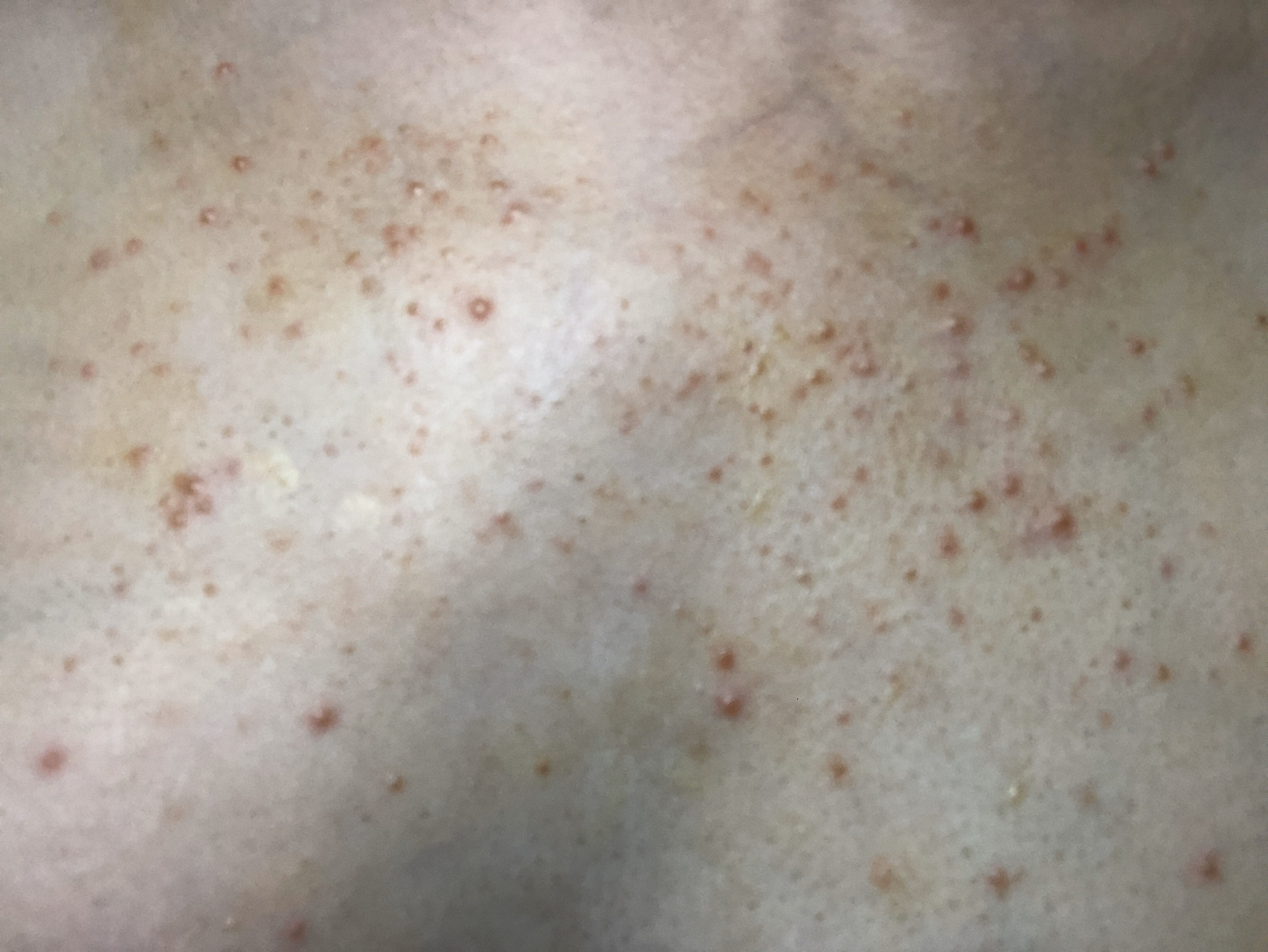 求马拉色菌毛囊炎方法,莫名其妙胸上面脖子以下长出
