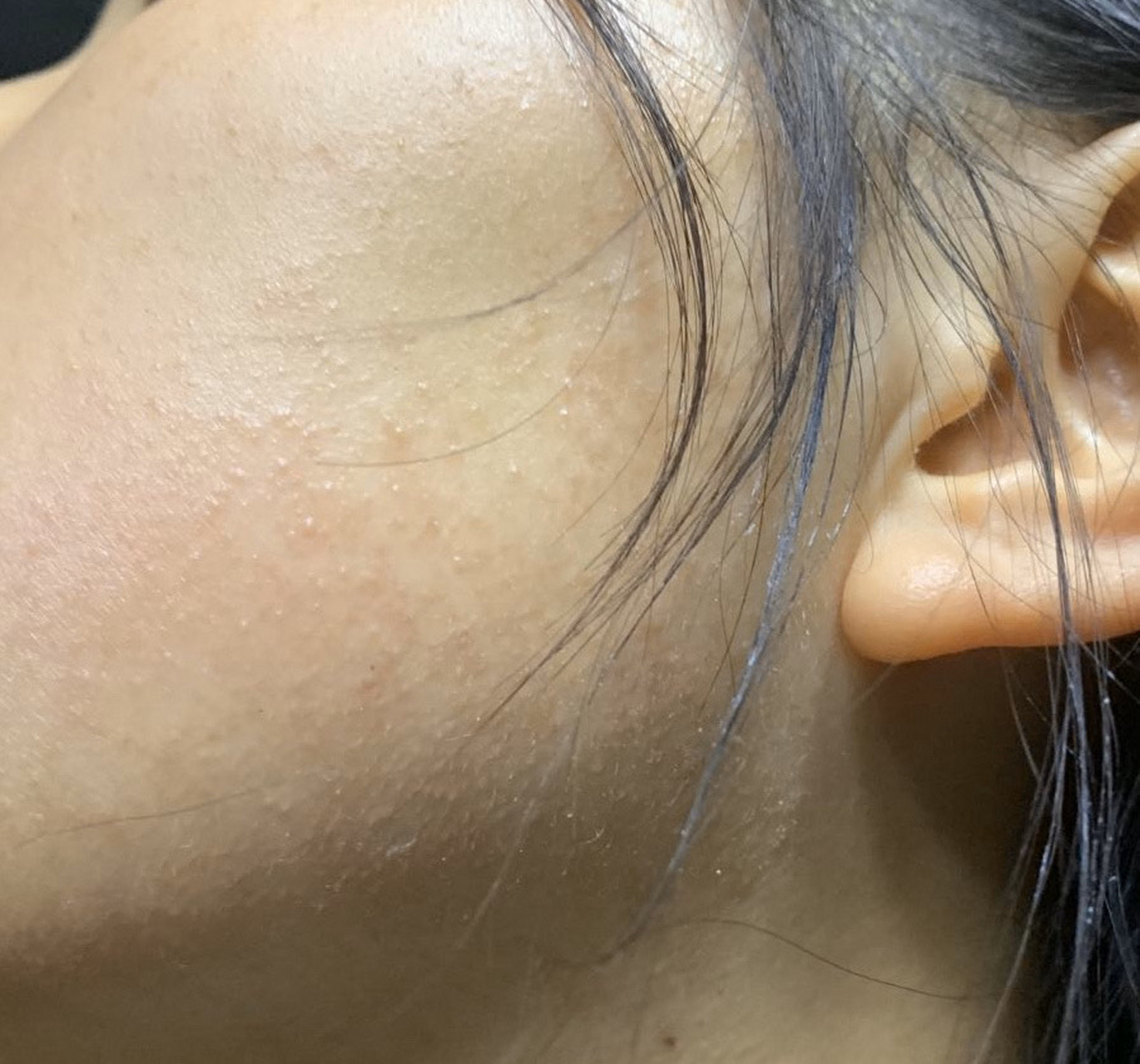 开个贴,记录一下毛周角化症的治疗过程.医生说可以治好,希望如此吧!