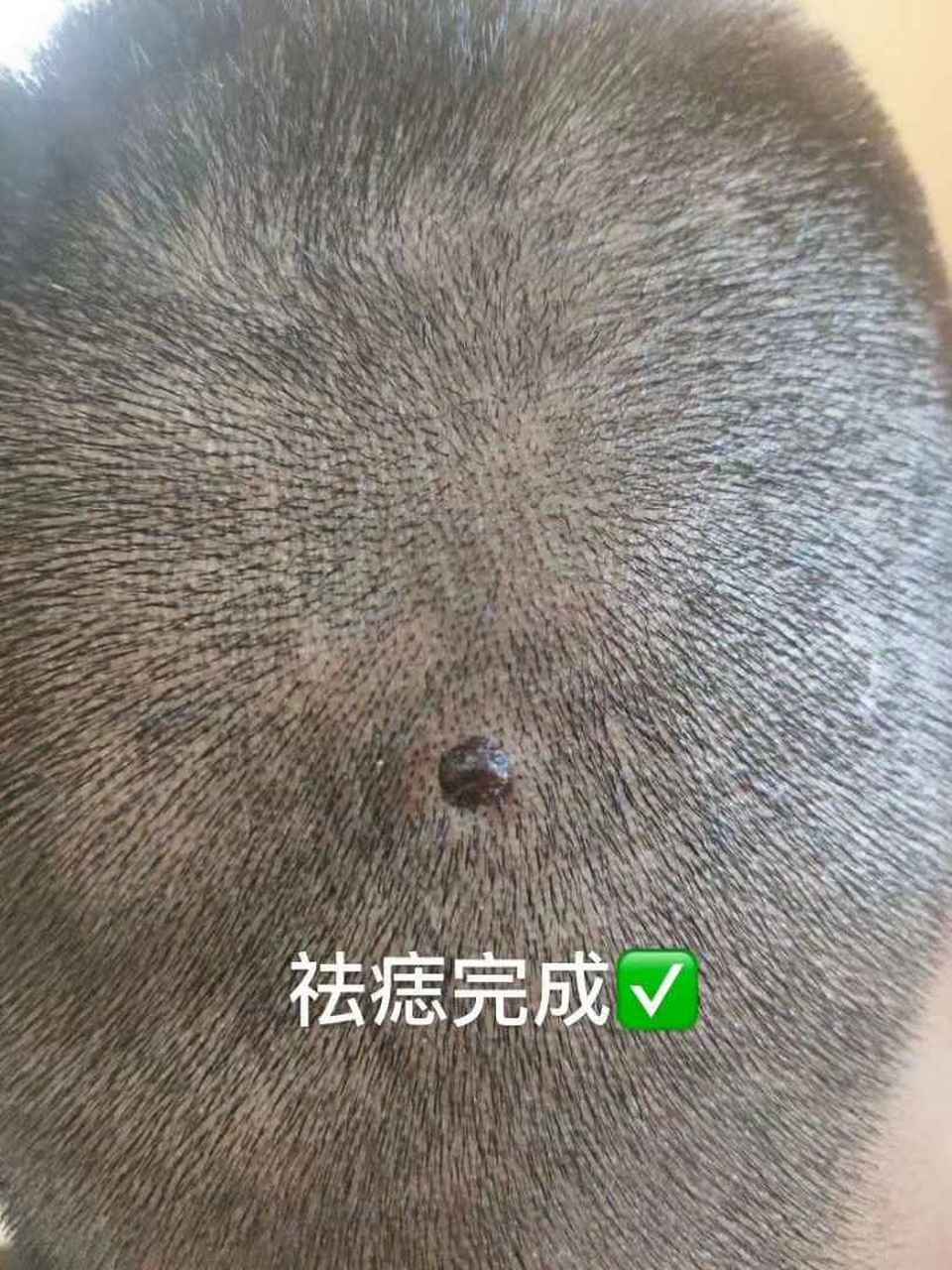 祛除大肉痣完成