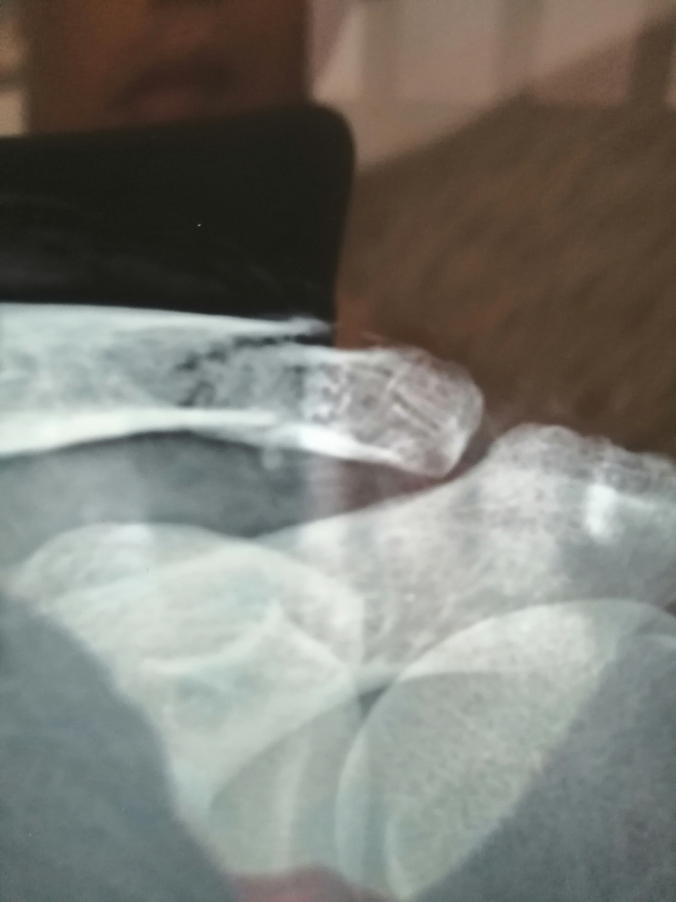 锁骨骨折保守治疗三十天了,今天拍的片子有懂的给看下长骨痂了没有?