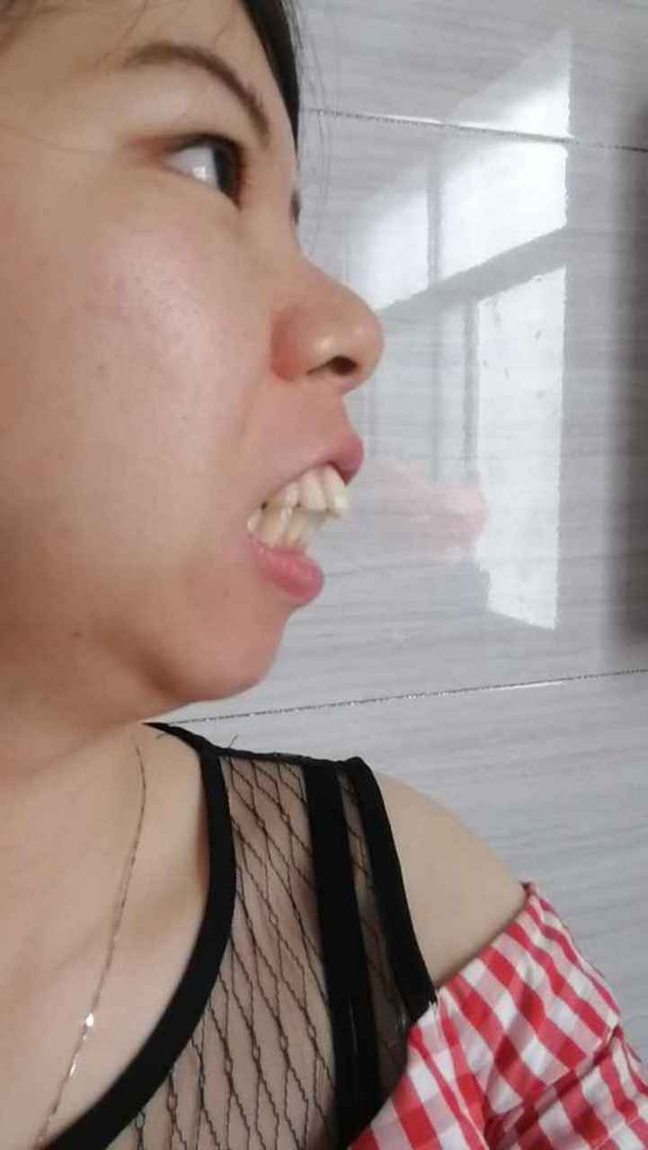 牙友们帮我看看骨性龅牙带牙套有用吗