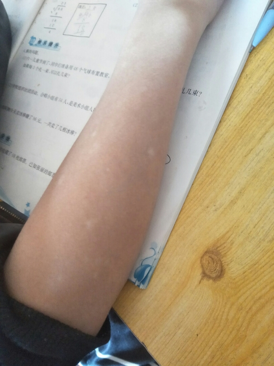 刚刚发现小孩手臂有白斑 会不会是白白