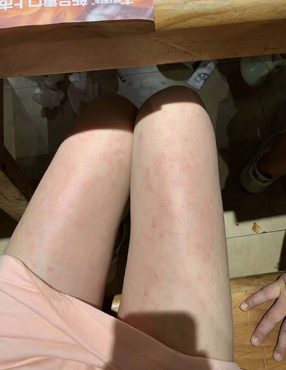 有没有和我一样吃海鲜过敏