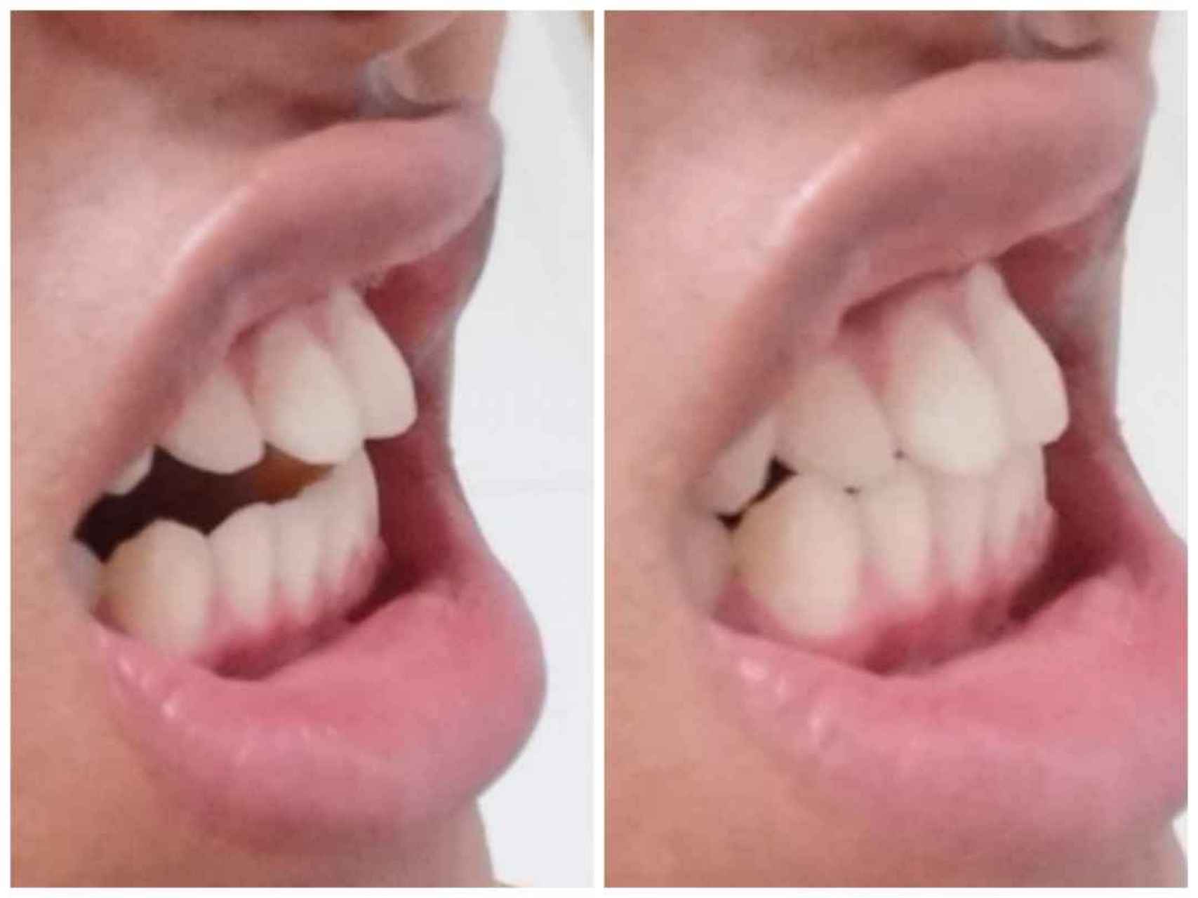 请问我这样的牙齿属于门牙前突还是凸嘴龅牙?需要带牙套吗,男20岁