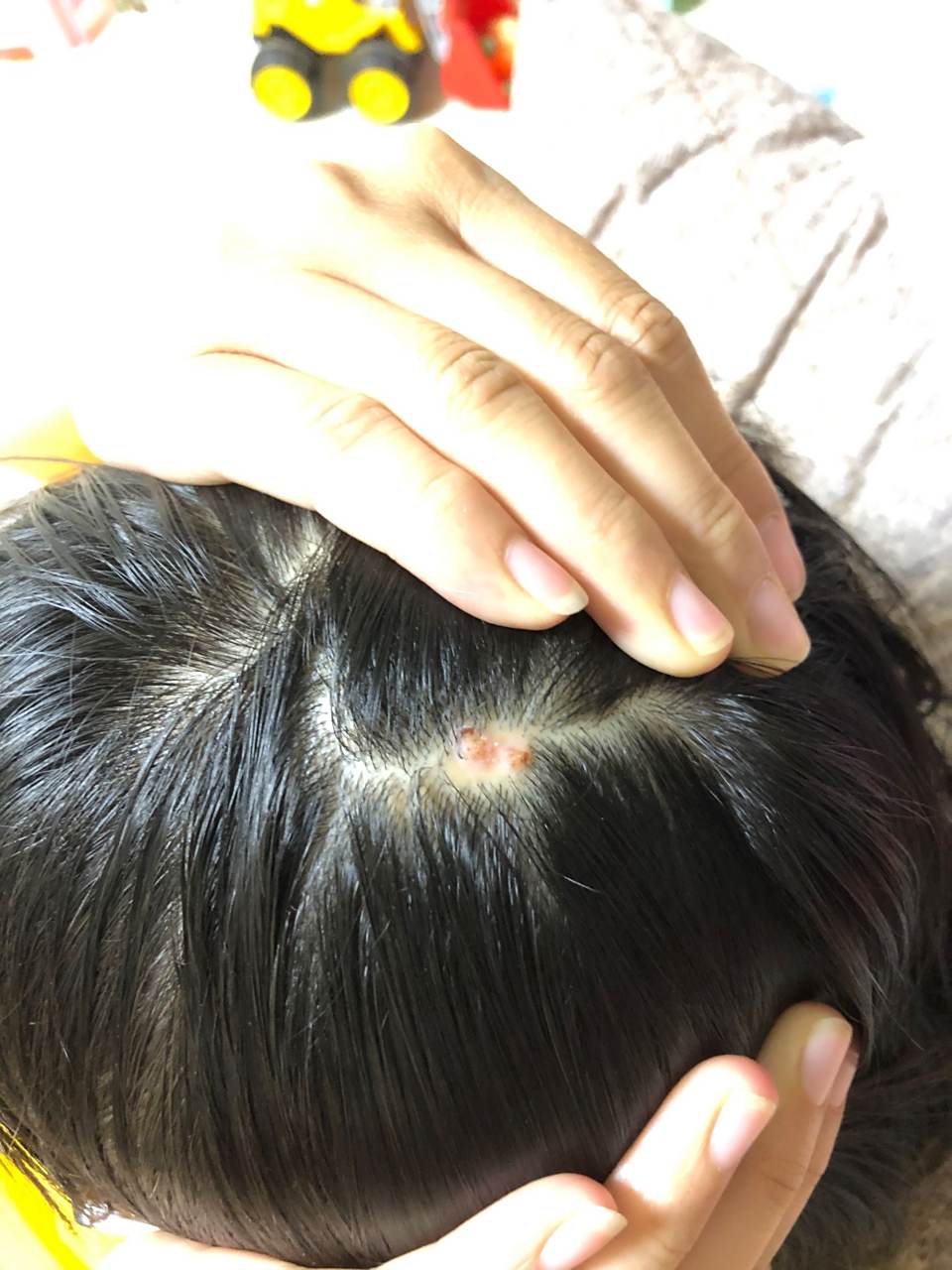 大家帮忙看下这个疣状痣还是皮脂腺痣,从小就有做过两次激光都没干净