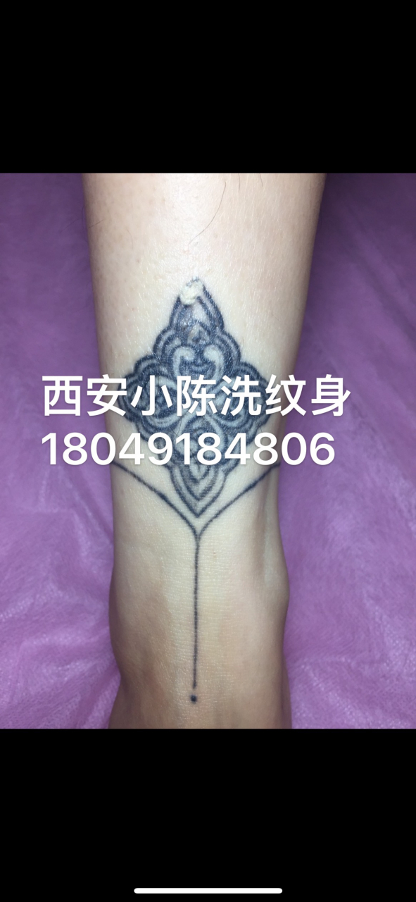西安哪里可能洗干净纹身?西安小陈洗纹身,四次记录.