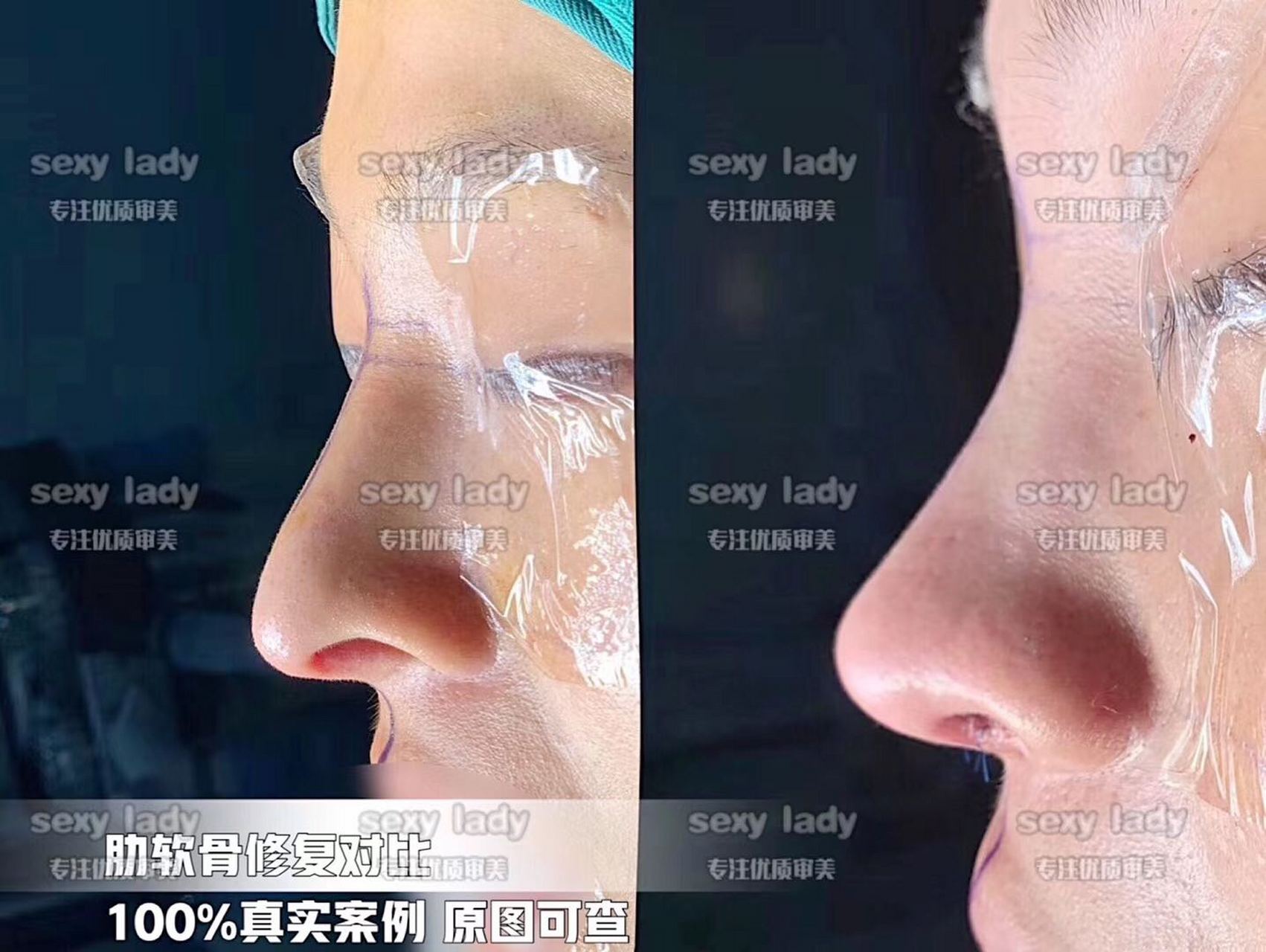 肋软骨鼻高难度修复  术前假体下滑 鼻背假体大幅度移动 层次放得浅