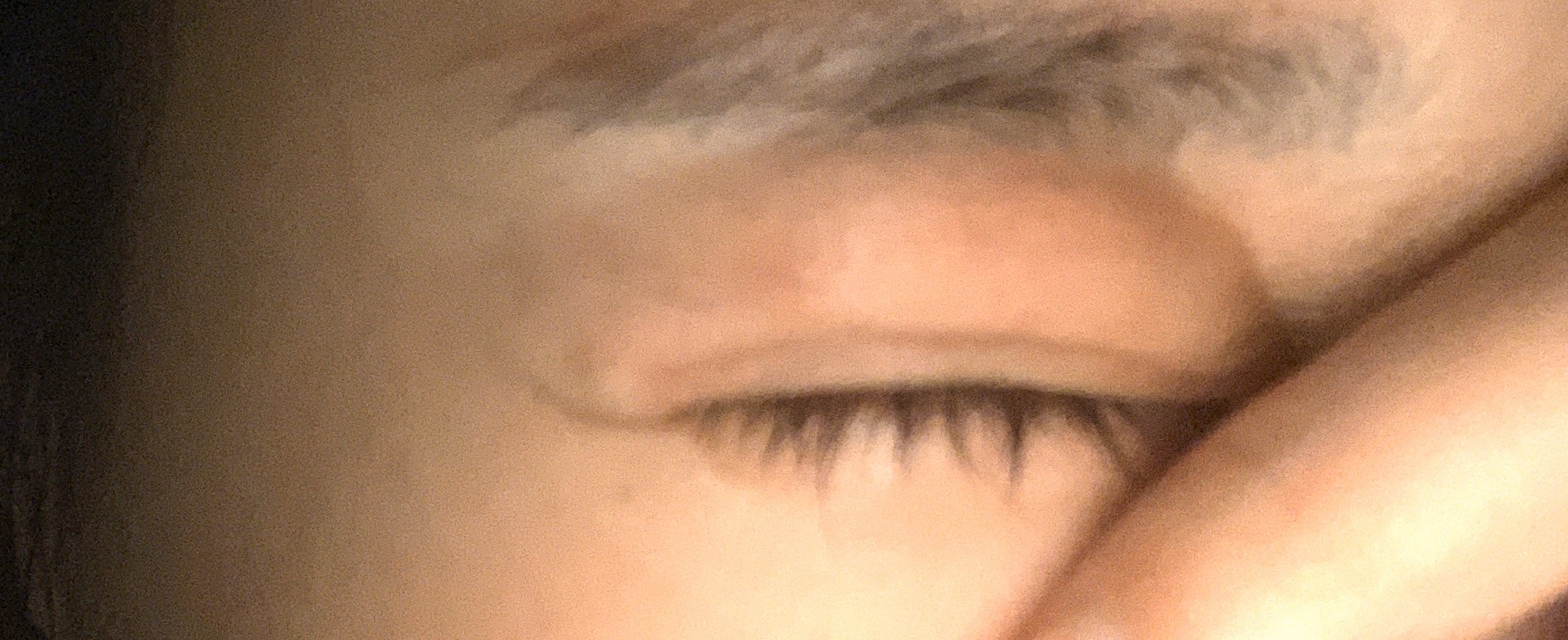 合肥庸医眼窝脂肪填充结块过量毁眼.