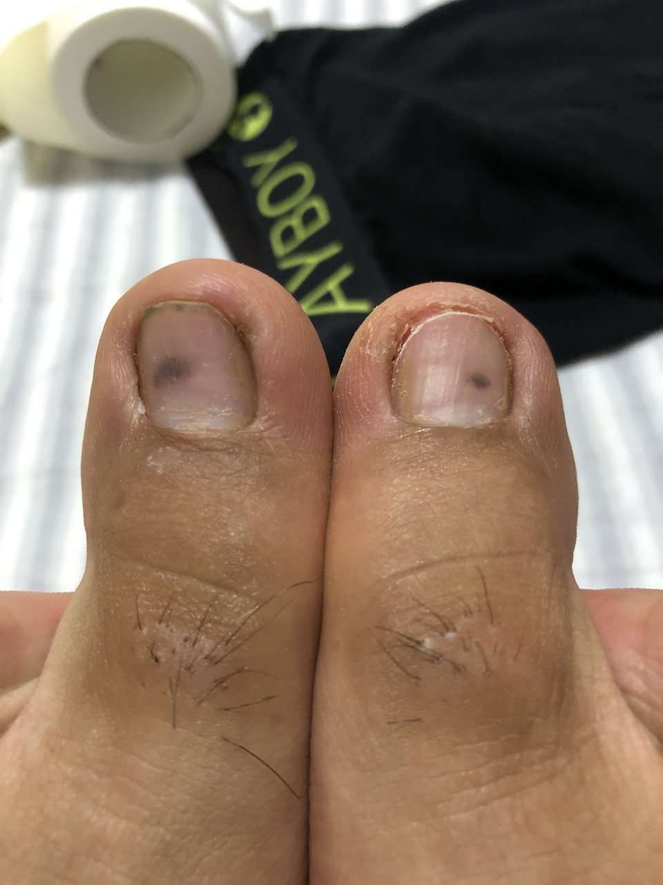 请问这样的对称大脚趾是黑色素瘤症状吗?