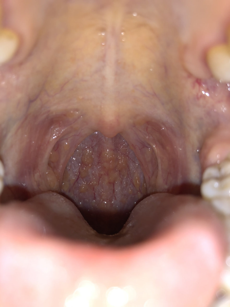 慢性咽喉炎 喉咙异物感强烈 吃什么药都不见好,都小半年了,我才二十多