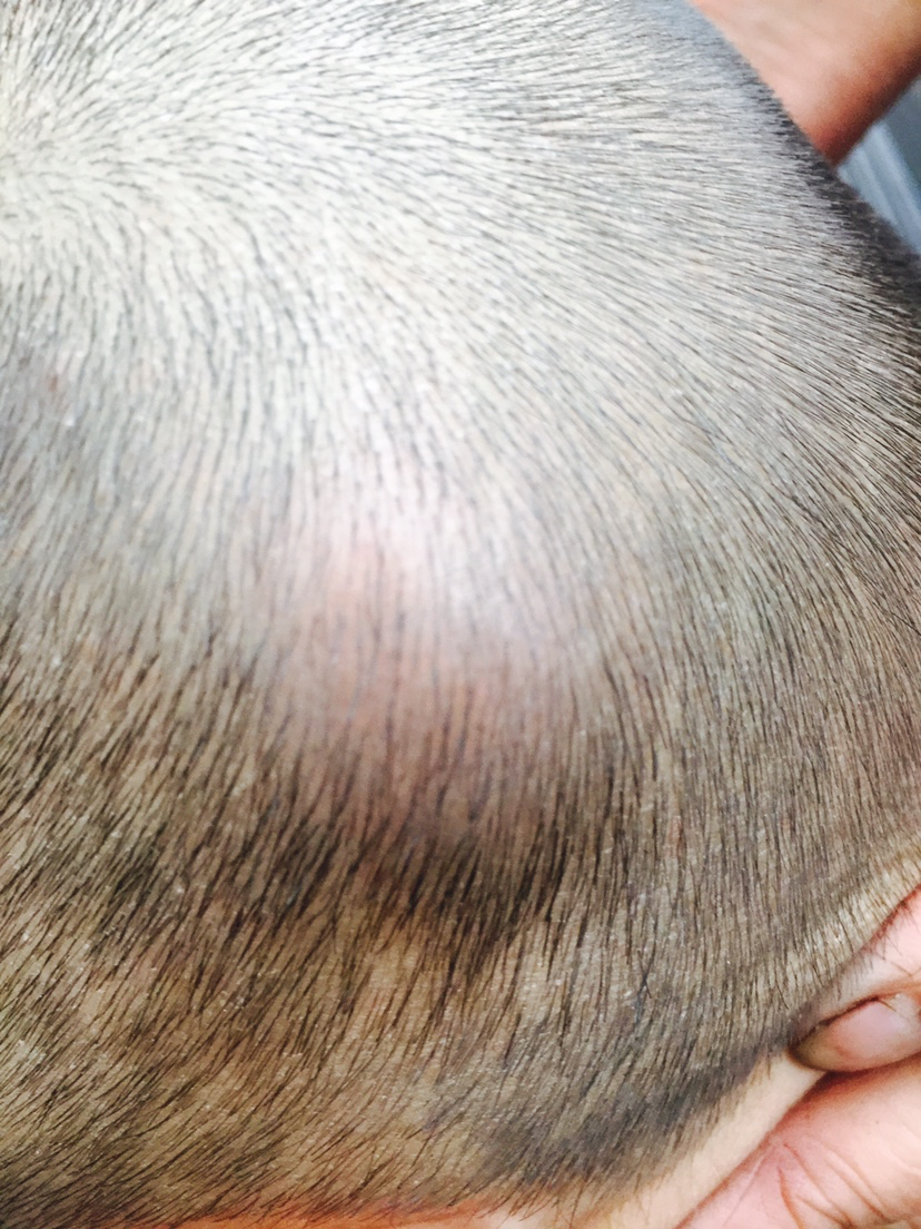 小孩5个月了,今天上午床上掉下来了,头上起了个包,医院也去了,他不