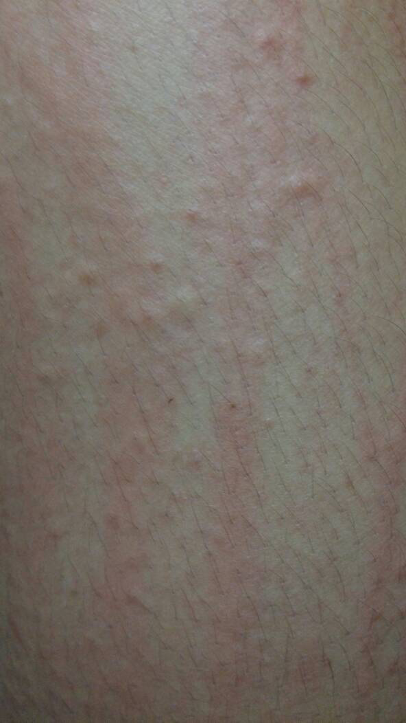 为什么一热身上就痒起疙瘩为什么在线