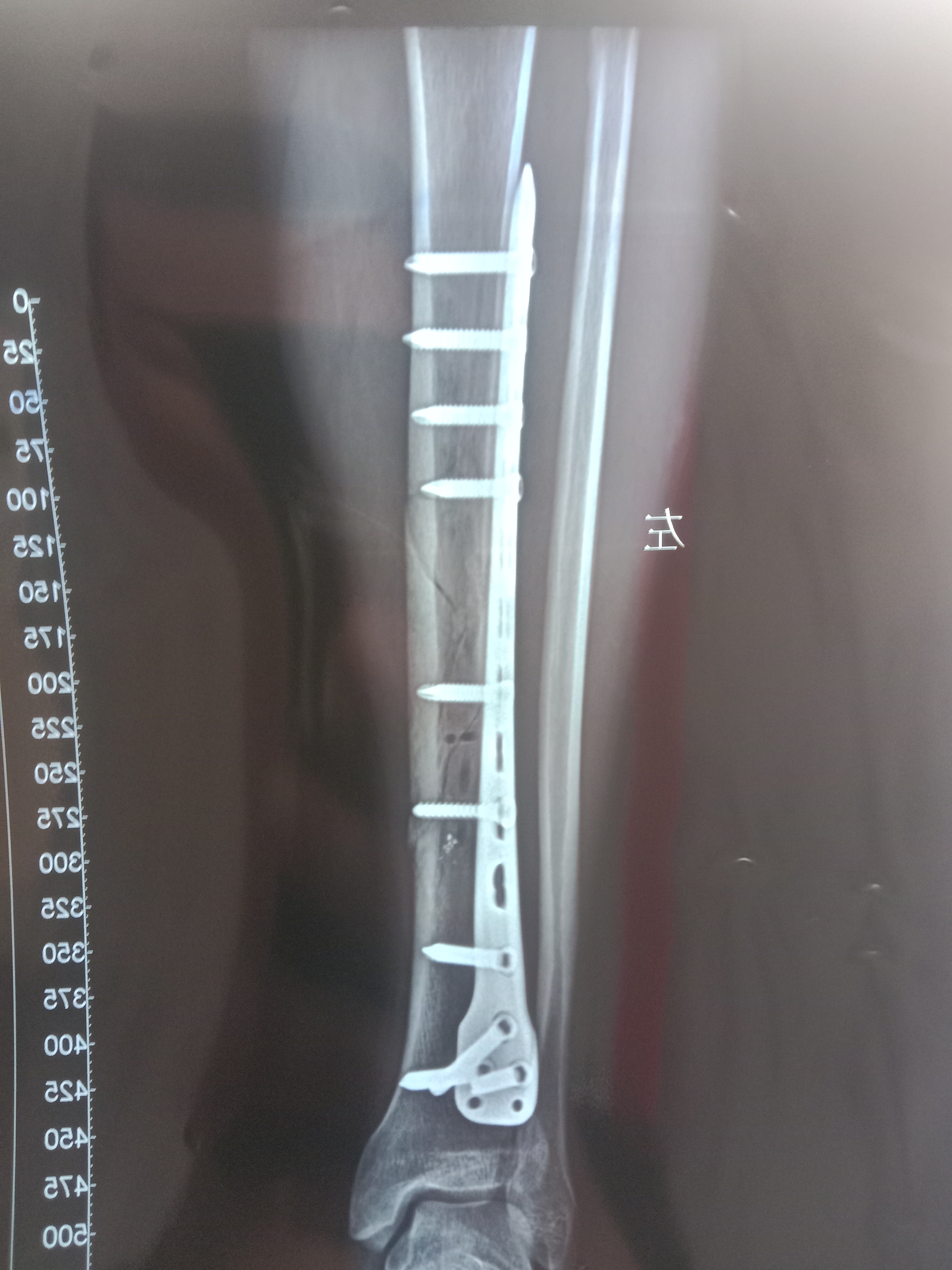小腿骨折手术 骨头接到这种程度可以吗 影响以后恢复速度吗