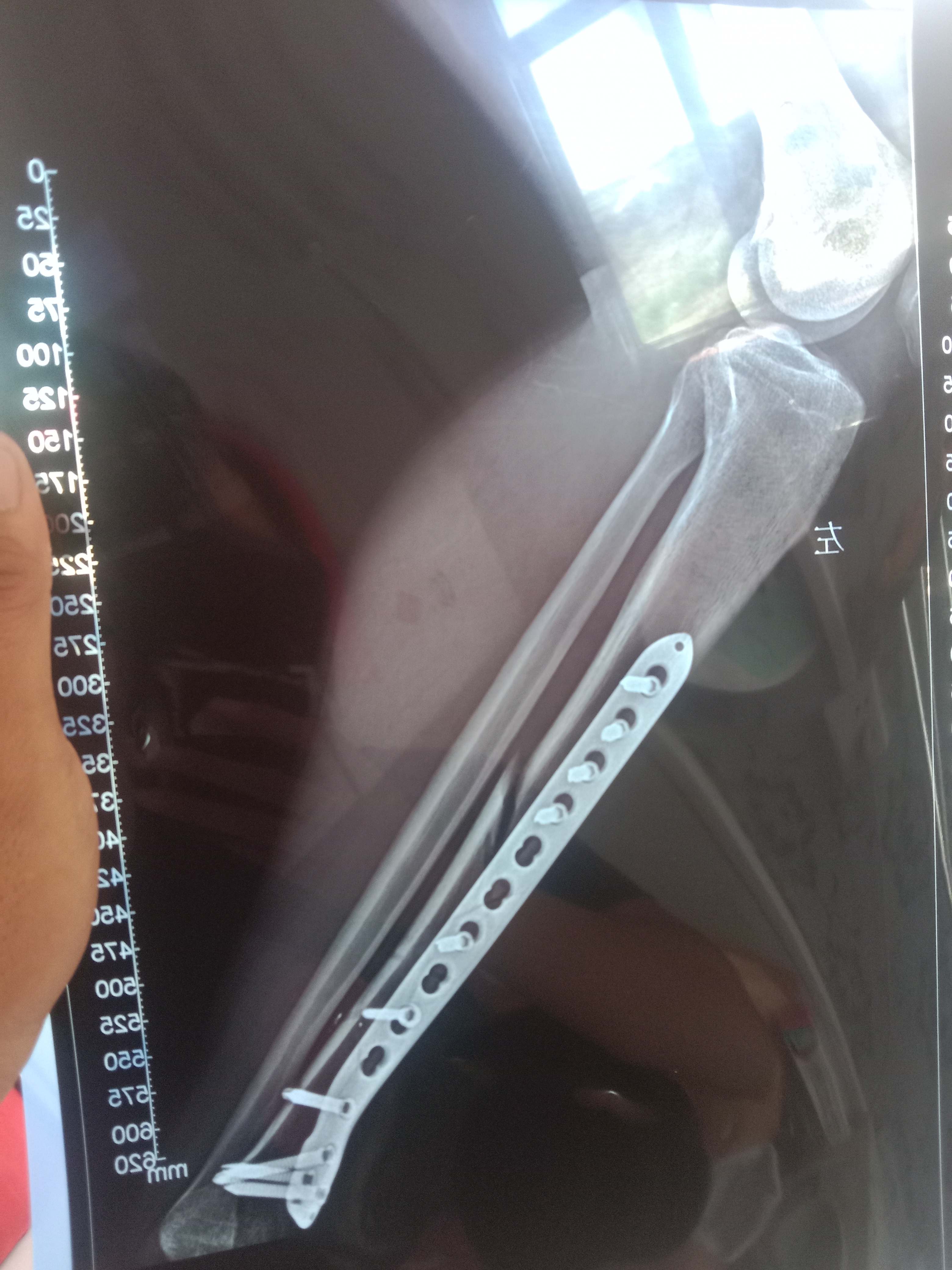 小腿骨折手术 骨头接到这种程度可以吗 影响以后恢复速度吗