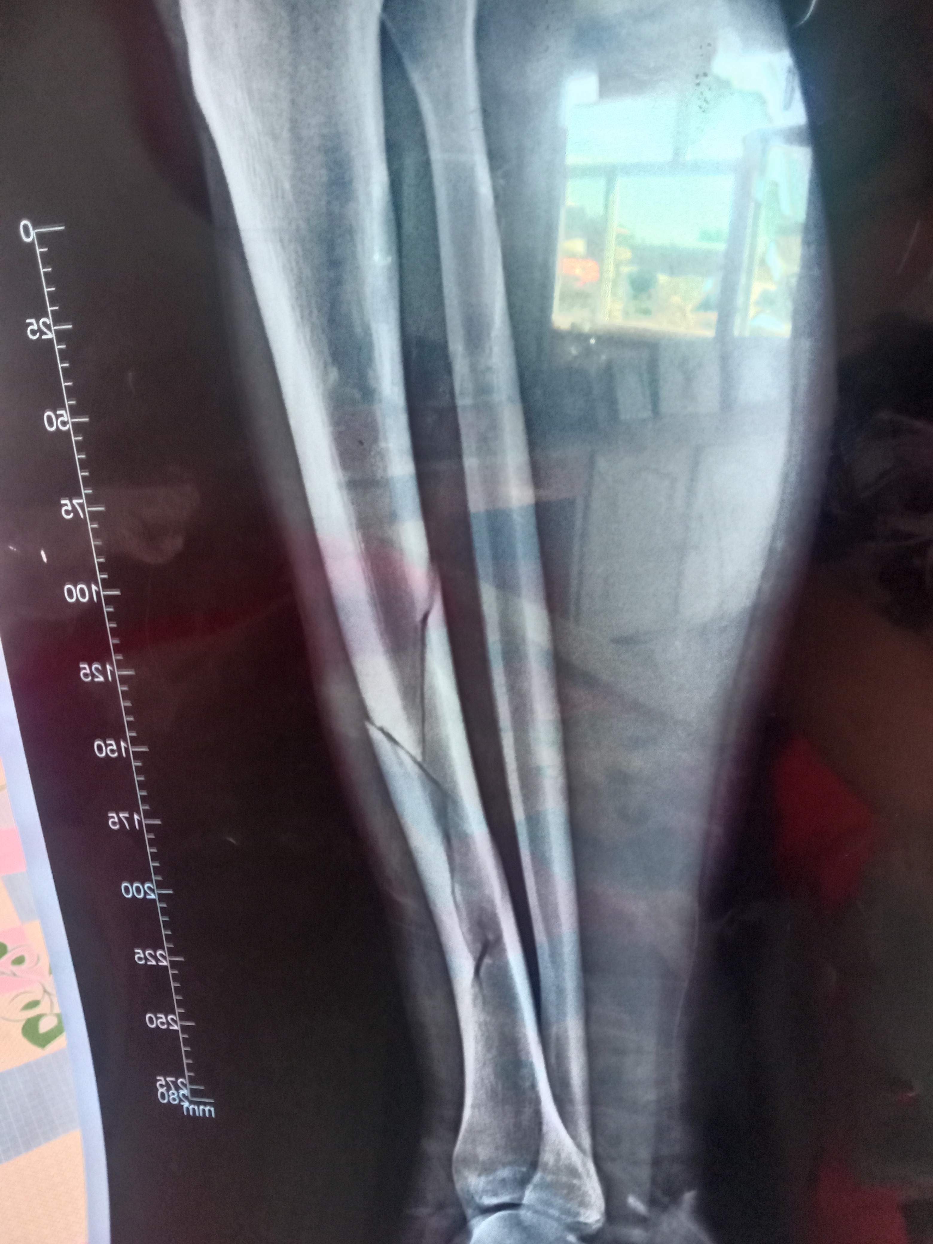 小腿骨折手术 骨头接到这种程度可以吗 影响以后恢复速度吗