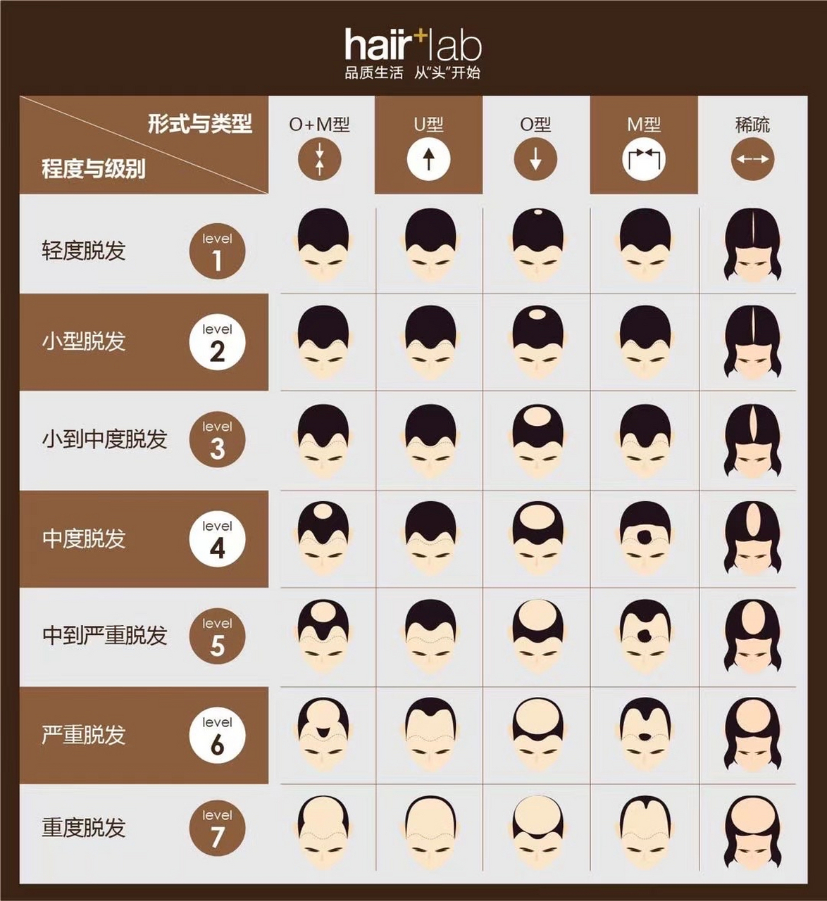 [让我看看]汉密尔顿脱发分类等级 查看你已"脱"到了哪一等级?