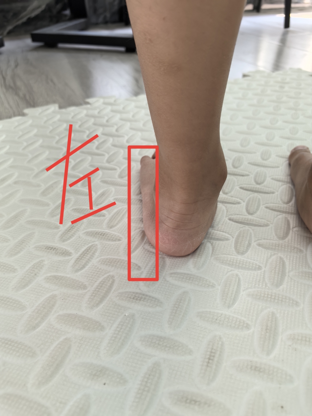 这是今天早上来找我的一个足外翻的4岁小宝宝,让人心疼!