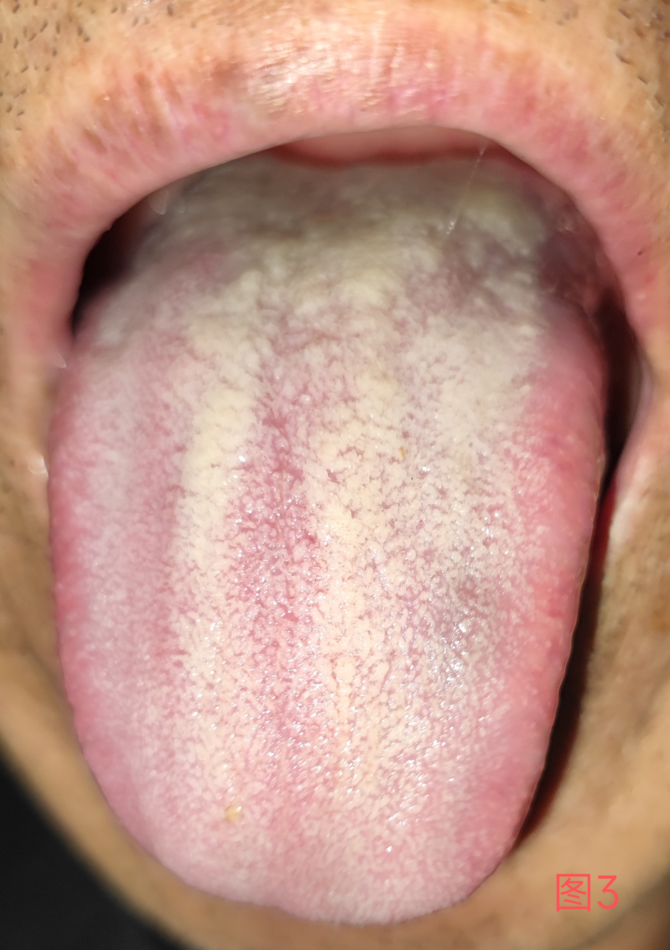 2021年10月份开始中药调理一个月后舌质舌苔有明显变化看图2,现如今