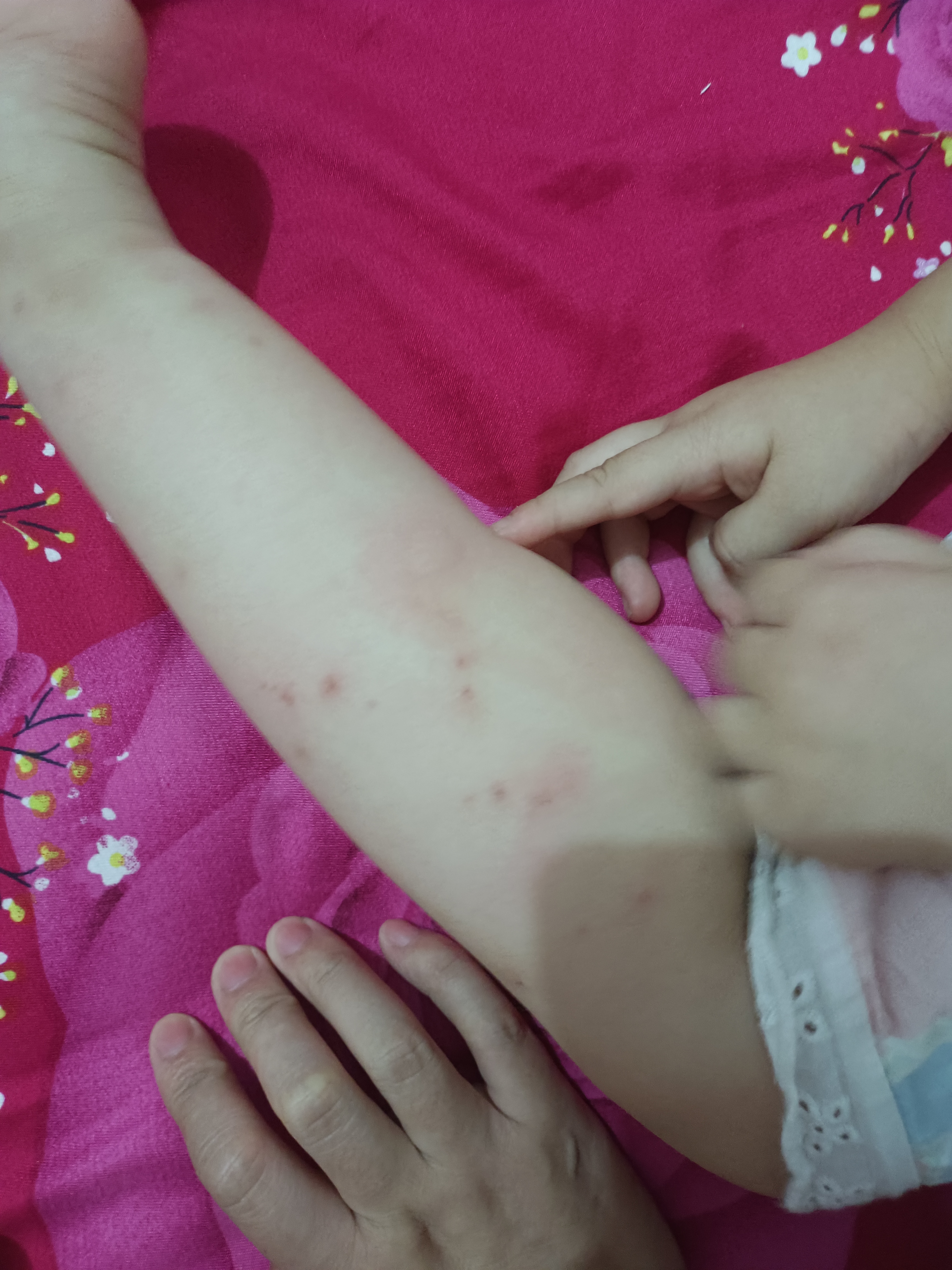 这么大的包!蚊子的爱真是承受不住啊!你家雨后也是蚊子猛增么?