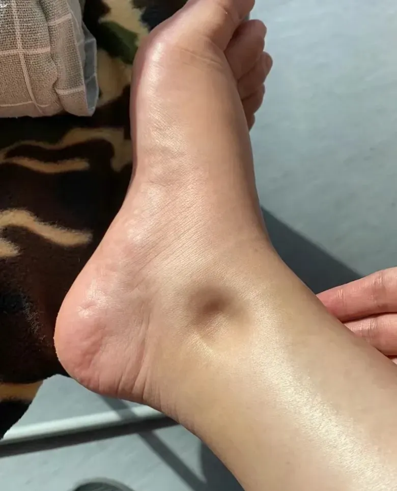 之前出去玩了一天走了快3万步回来也是水肿的不成样子脚水肿凹陷性