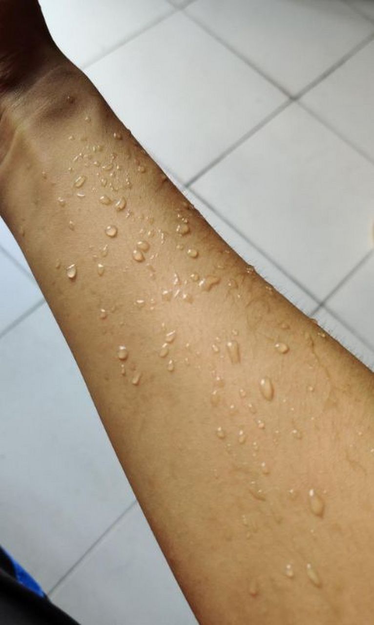 刚洗完澡手臂上就出现这种水痘,怎么办要不要叫救护车?