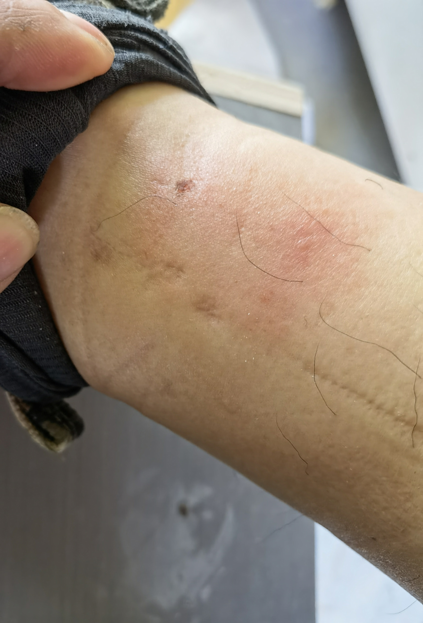 哪位大神知道这是什么虫子?咬人不觉得疼但是痒的厉害而且还红肿