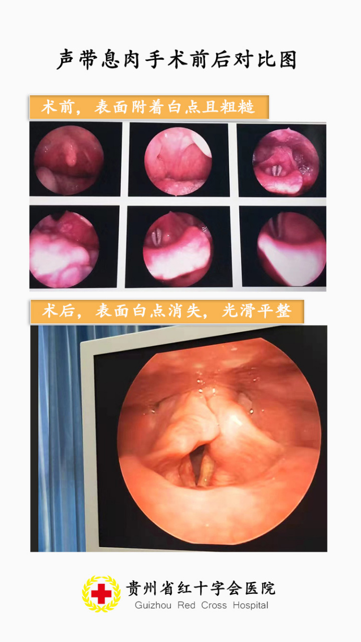 贵阳耳鼻喉专科医院# 患者咽腔粘膜慢性充血,悬雍垂居中,双侧扁桃体