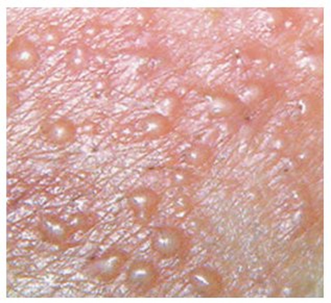 单纯疱疹(herpes  simplex)是由单纯疱疹病毒感染所致的病毒性皮肤病.