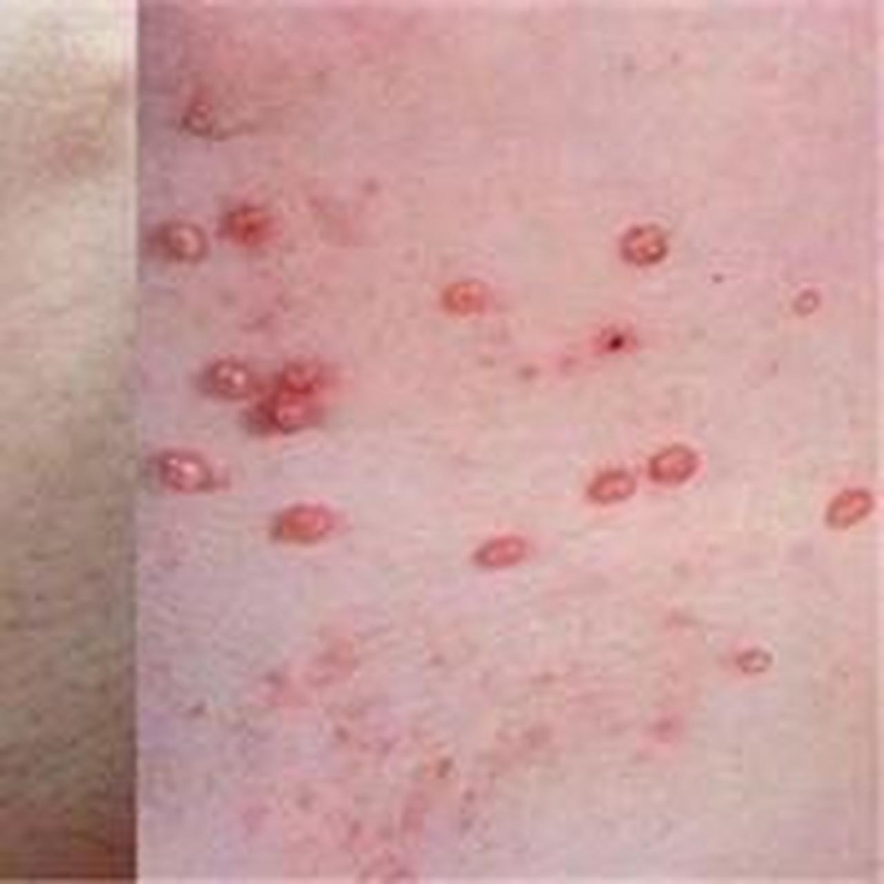 系结核杆菌通过皮肤破损直接感染后引起的增殖性皮肤损害.