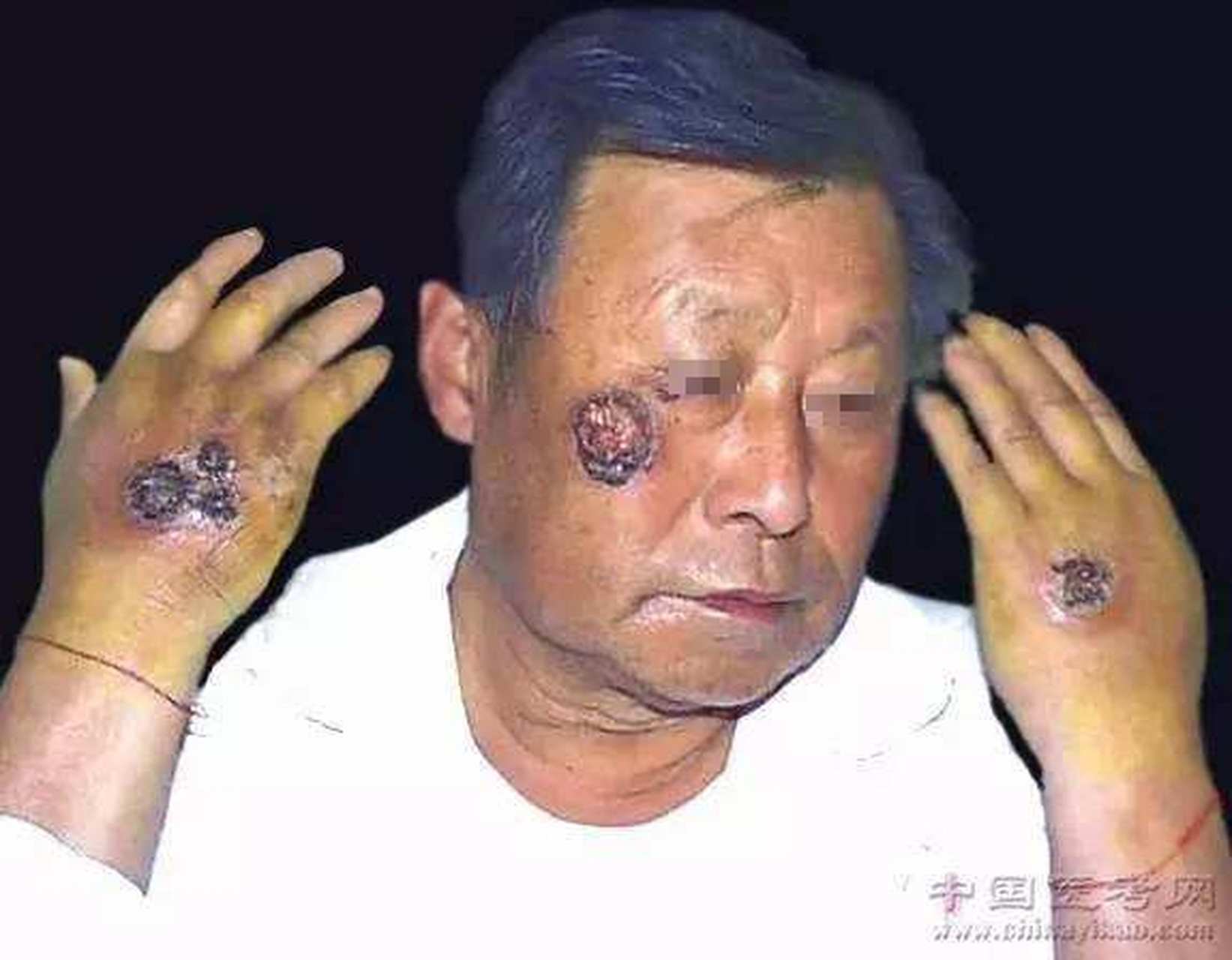 深脓疱疮(ecthyma)   又称为臁疮.