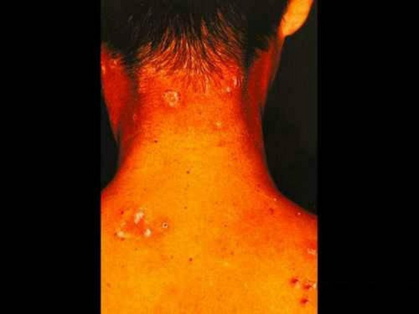 念珠菌病(candidiasis)是由念珠菌属(主要是白色念珠菌)引起的皮肤