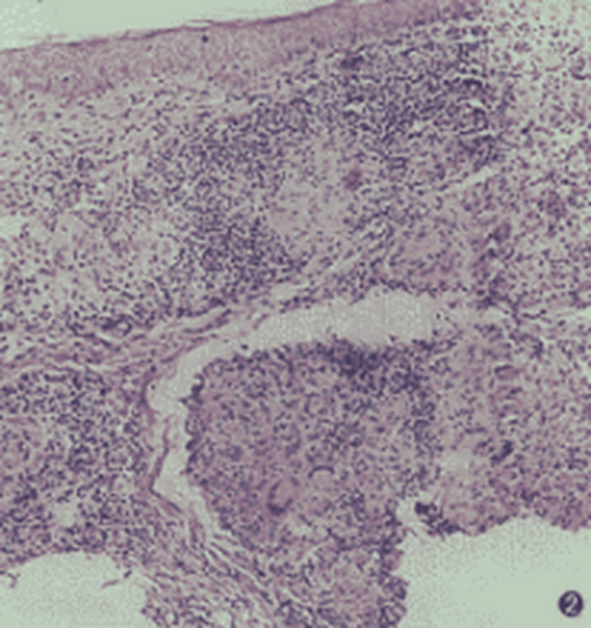 寻常狼疮(lupus vulris 最常见,约占皮肤结核患者的50-75.