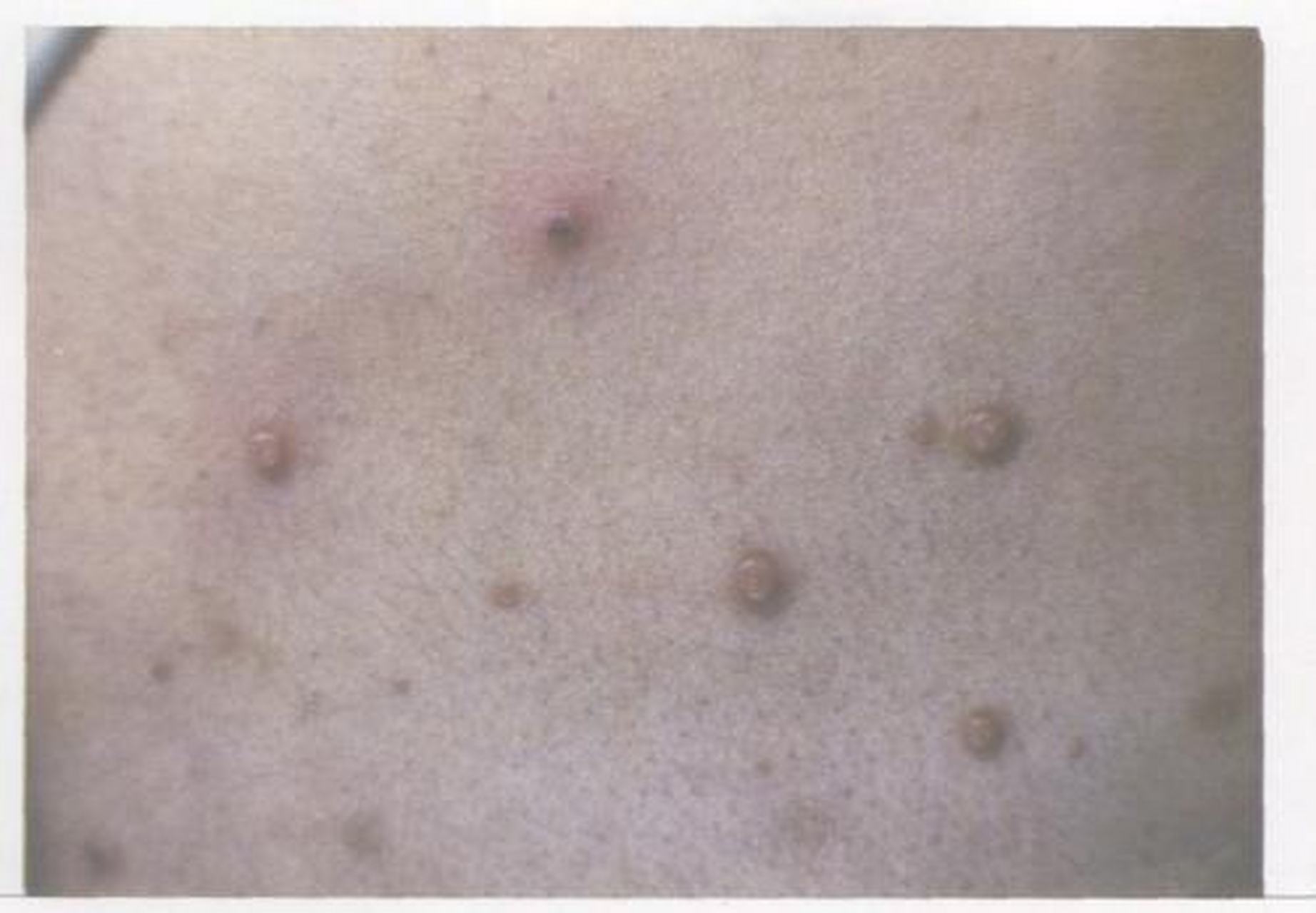 传染性软疣(molluscum  ontagiosum)中医学名为"鼠乳",俗称"水瘊子".