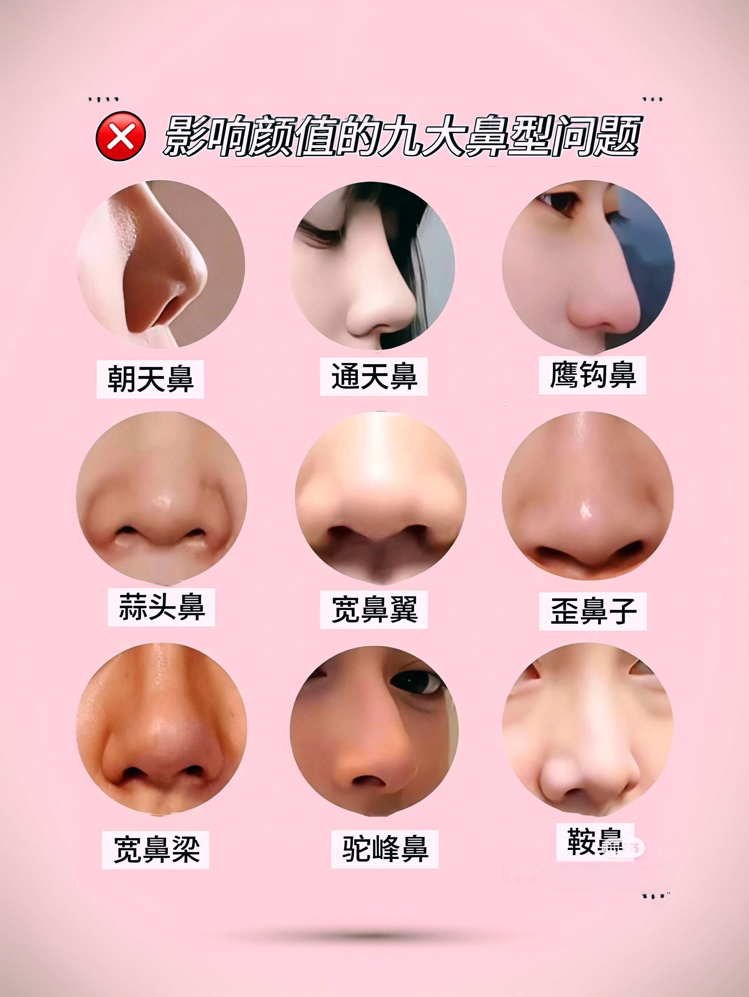 1朝天鼻:鼻孔朝天 2通天鼻:鼻子通天 3鹰钩鼻:鼻尖下旋 4蒜头鼻:鼻头