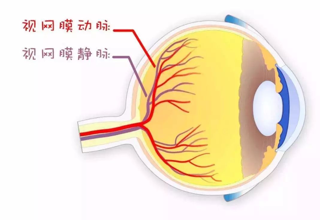 虹膜新生血管图片