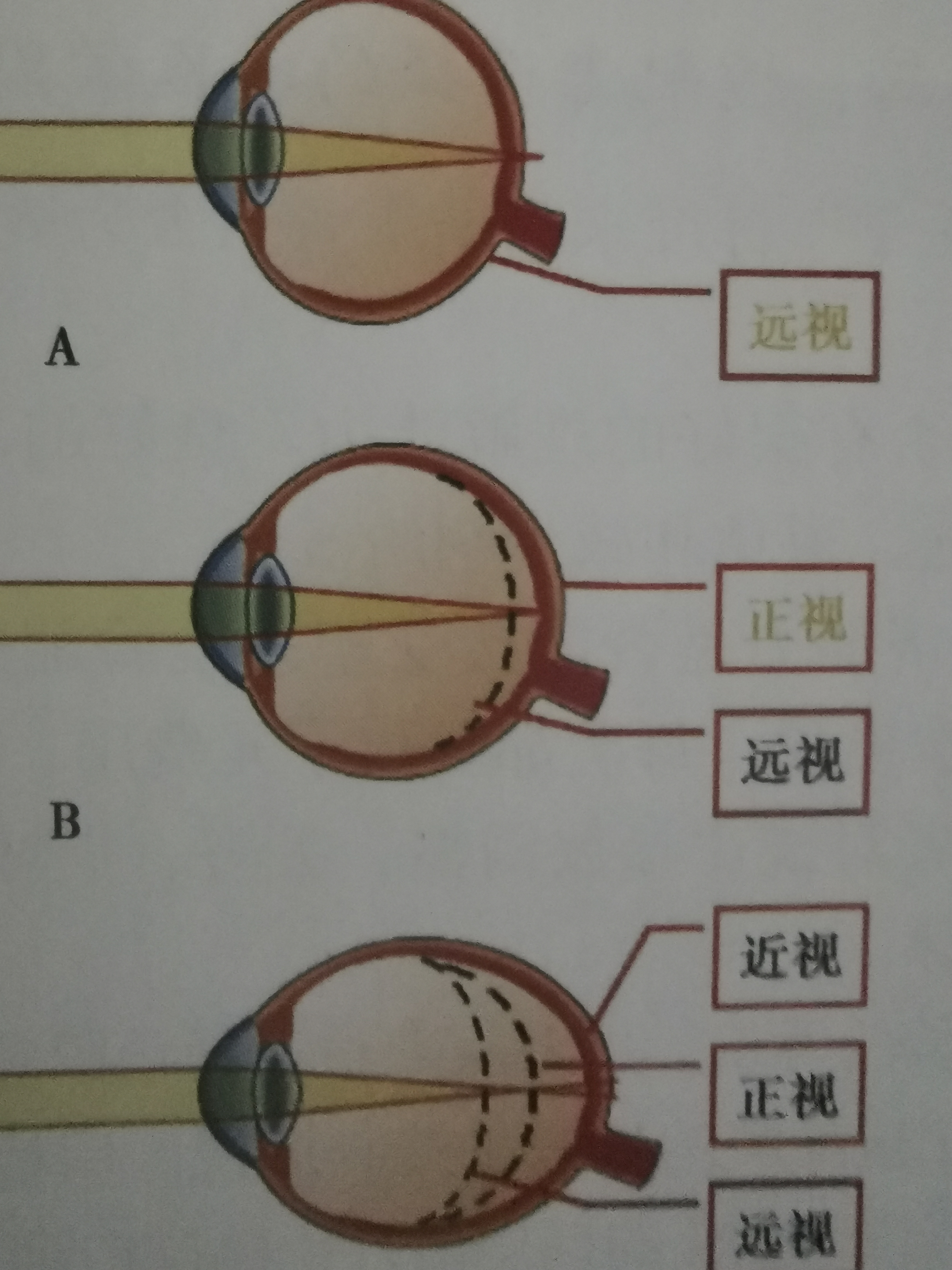 再谈儿童近视防控的误区 第一,认为视力1.
