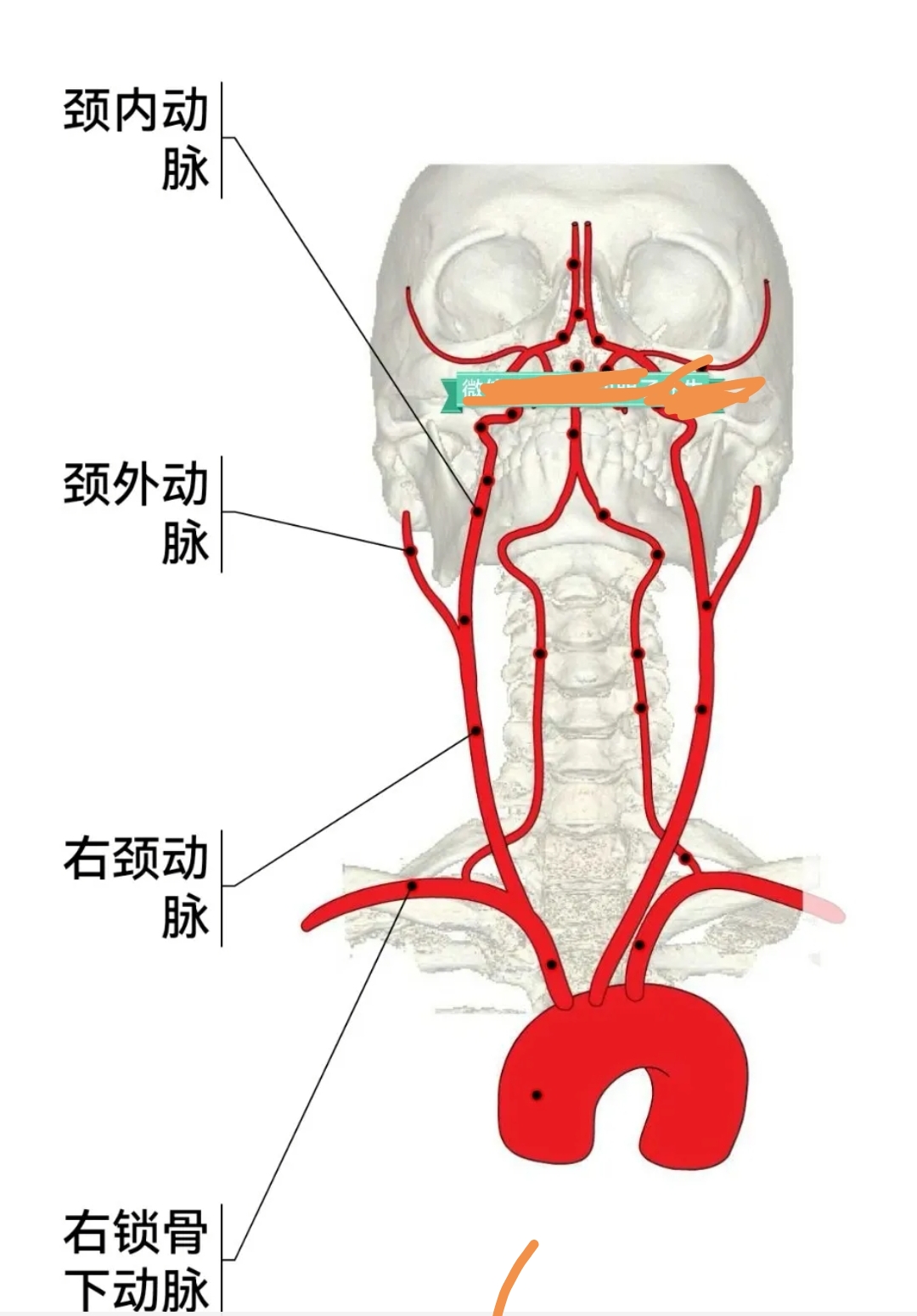 颈动脉小球位置图片