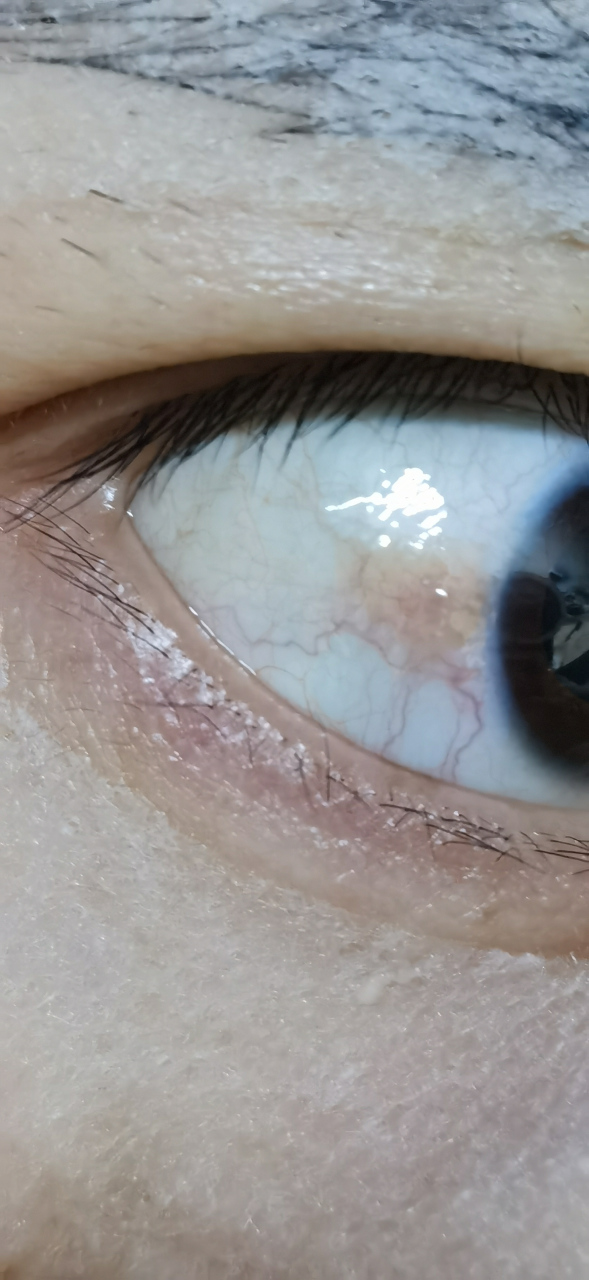 眼睛巩膜黄斑 我的右眼巩膜上有个黄斑,有点红,在网上买了个日本的眼