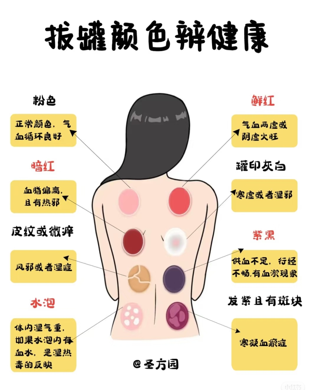 拔罐后的后背显显出的不同颜色,可以判断出对应身体不同部位的健康