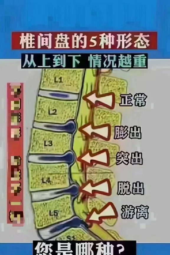 拖→→椎间盘膨出98 再拖→→腰间盘突出98 还拖→→腰间盘脱出