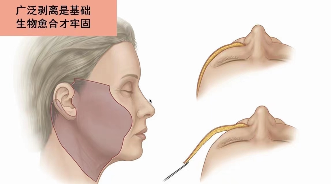 颞肌贴敷手术过程图解图片