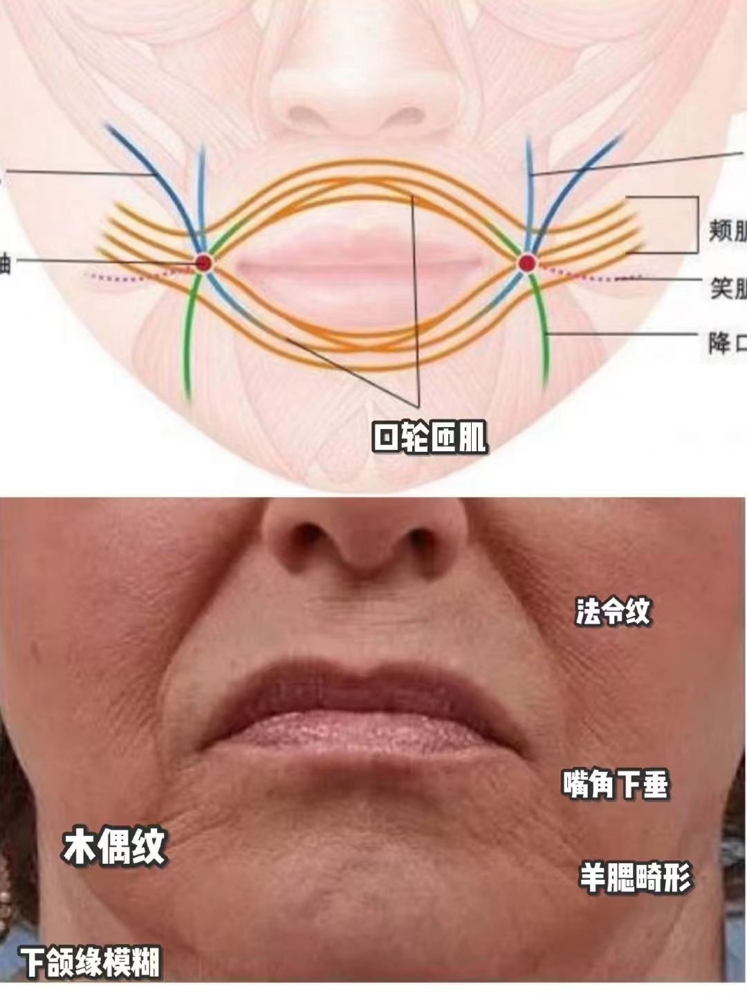 嘴角两边有皱纹图片图片