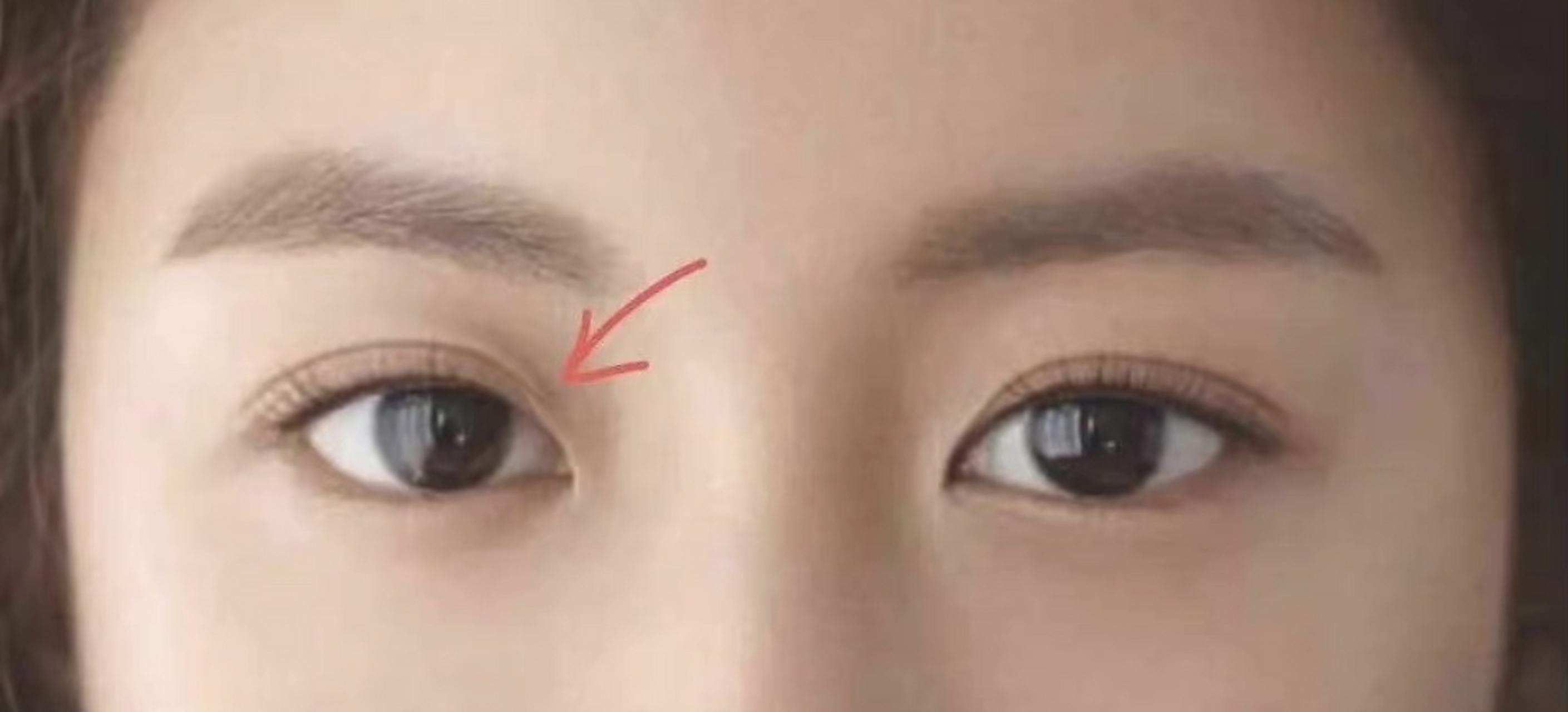 割双眼皮后出现褶皱,一般分为眼头分叉和眼尾分叉  眼头分叉主要这3种