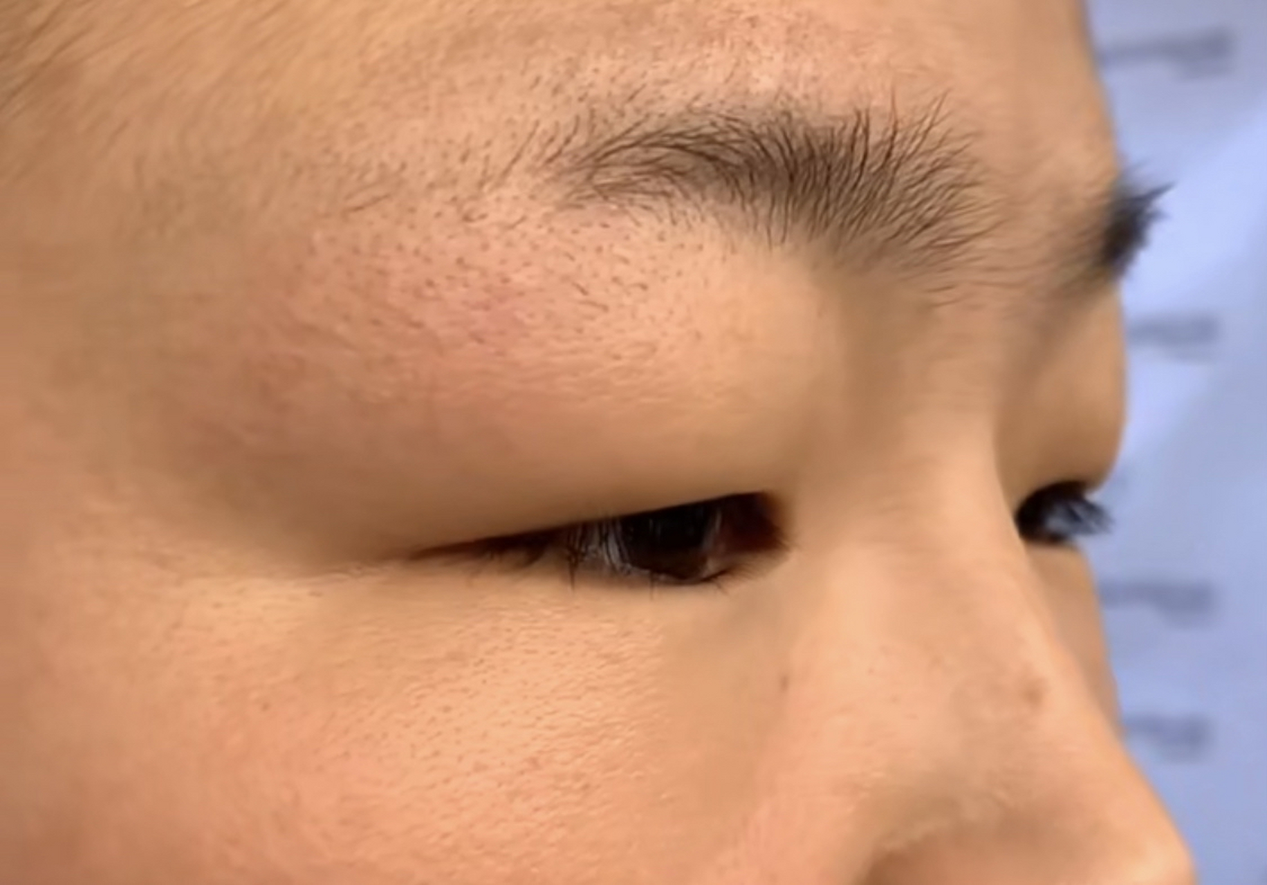 【肿眼泡割双眼皮后会容易产生肉条感吗?