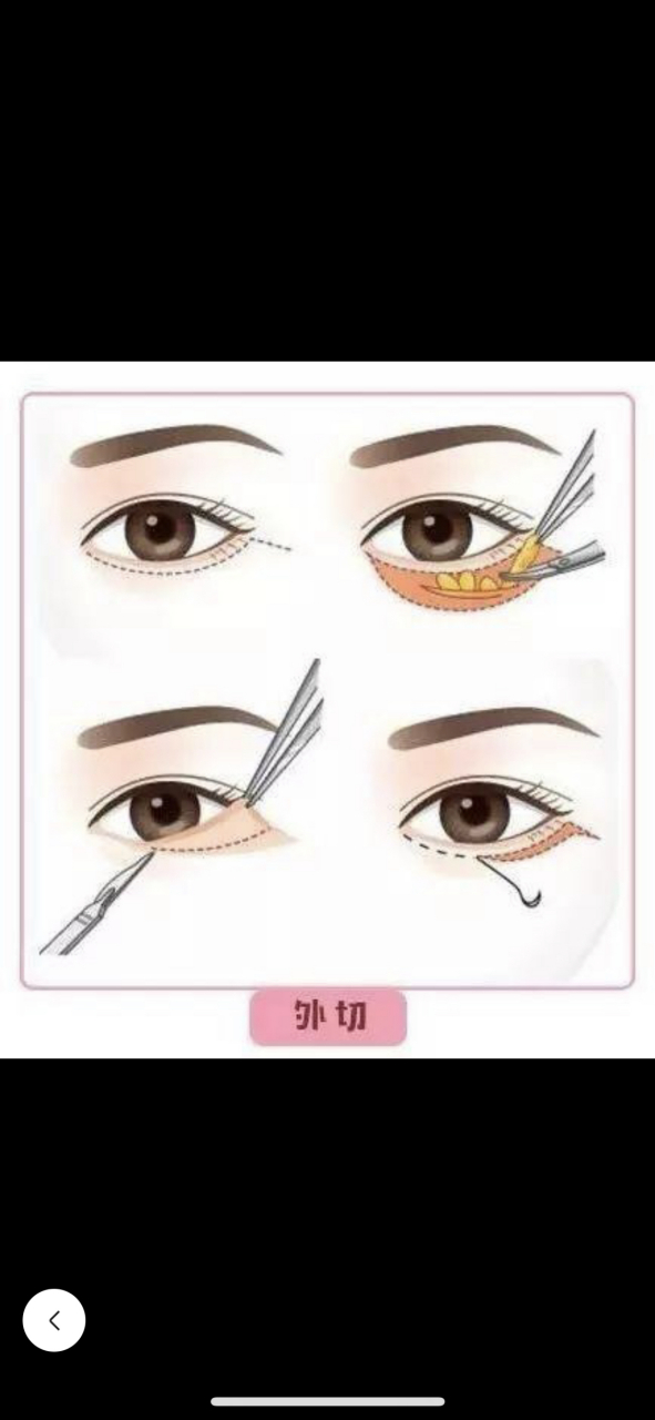 眼睑缺损要怎么修复?