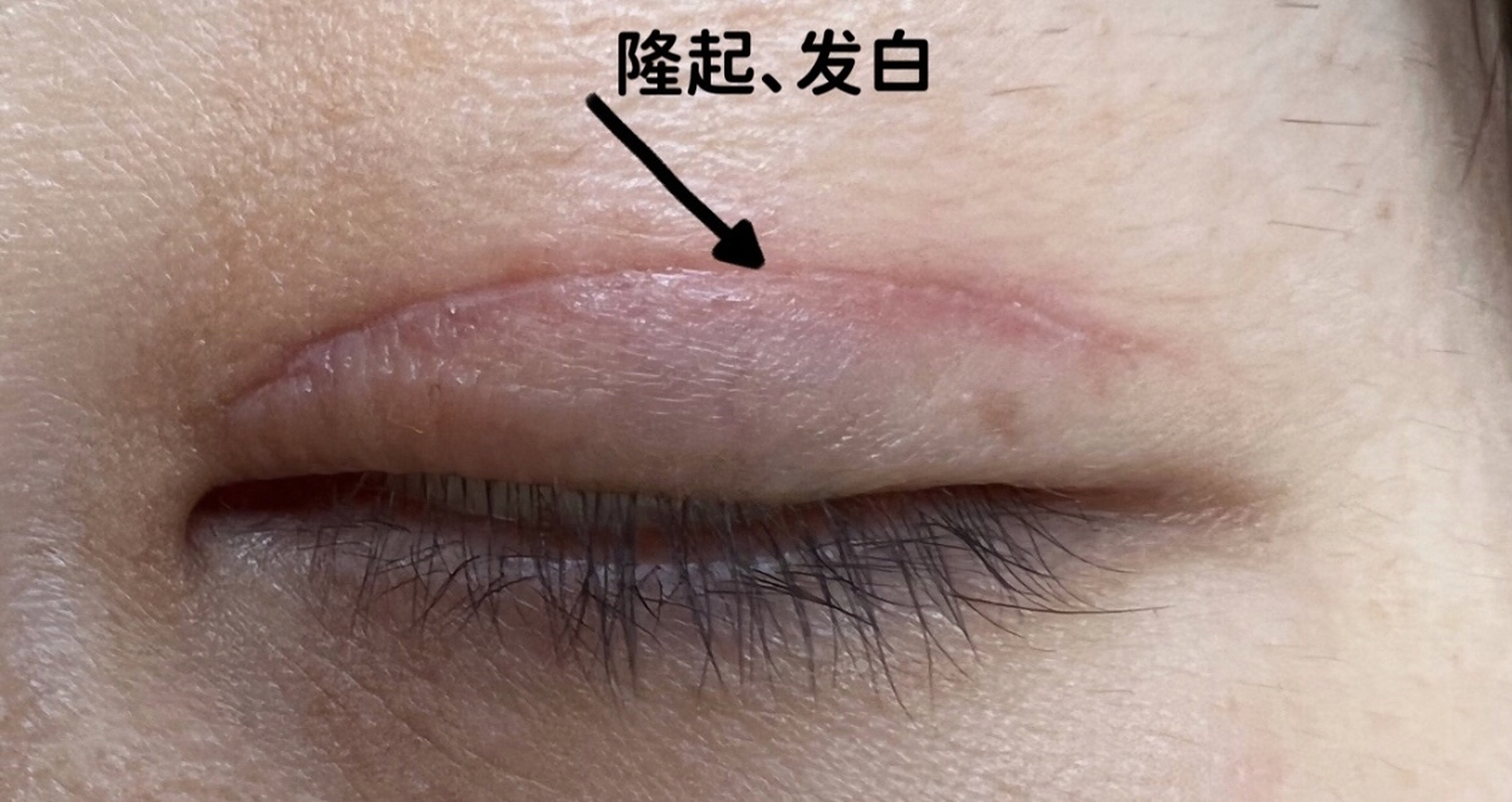 一,该如何判断双眼皮术后切