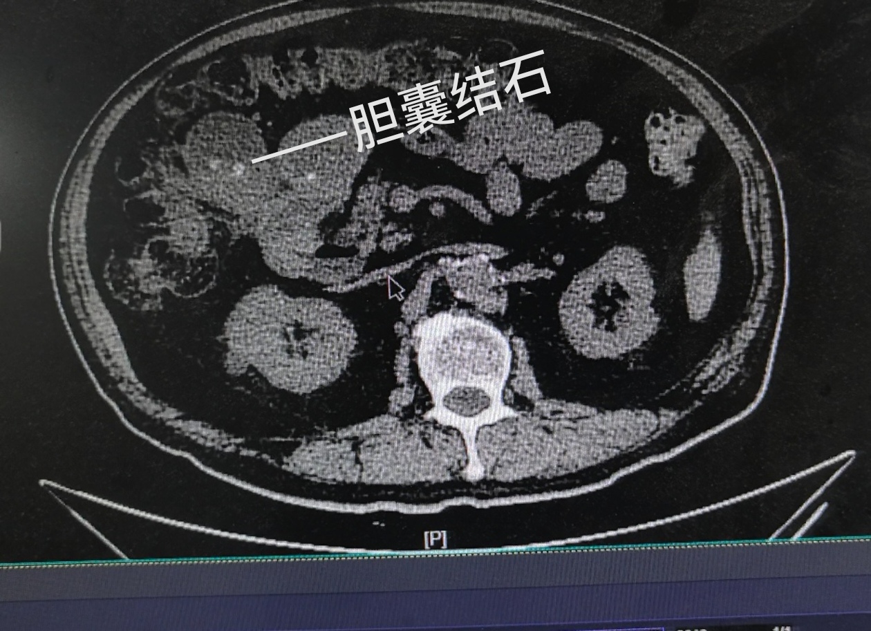 患者男性69岁,3年前体检发现胆囊结石,胆囊壁增厚毛糙