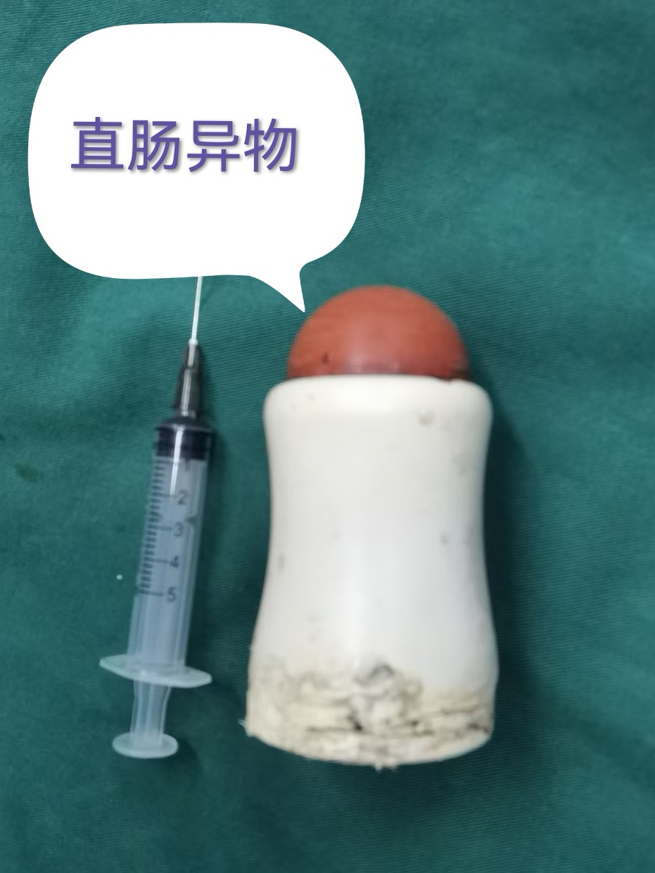 我随到手术室,观察直肠异物是直径约5cm的瓶状物,底朝下口朝上