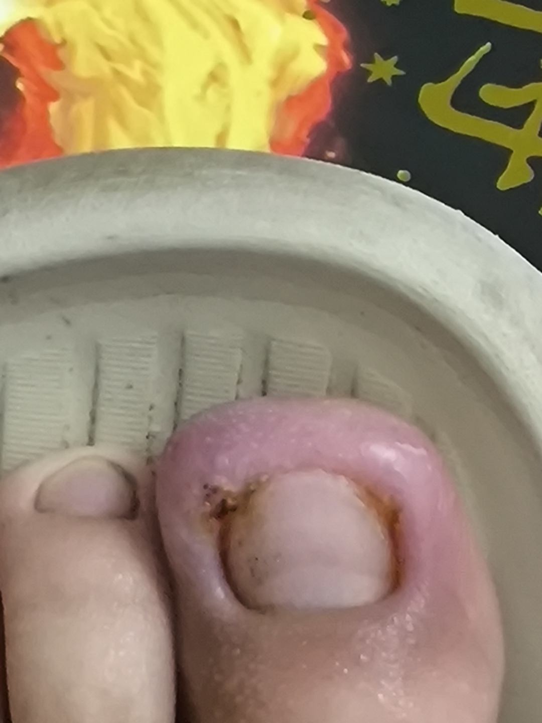 甲沟炎这样了还能治好吗.求教